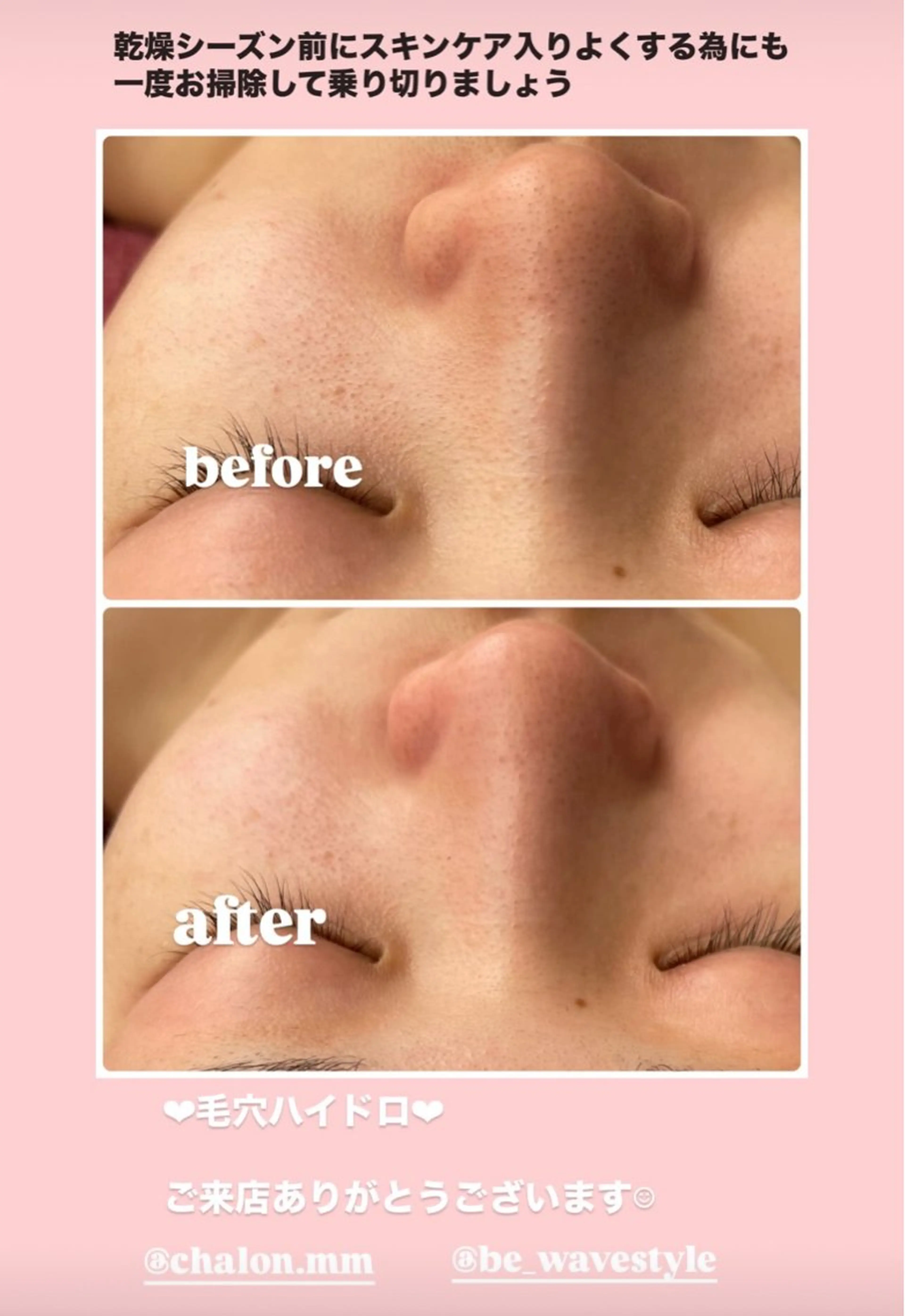 エステ Chalon所属・REVI取扱・肌悩み 毛穴Chalonのエステ・リラクイメージ