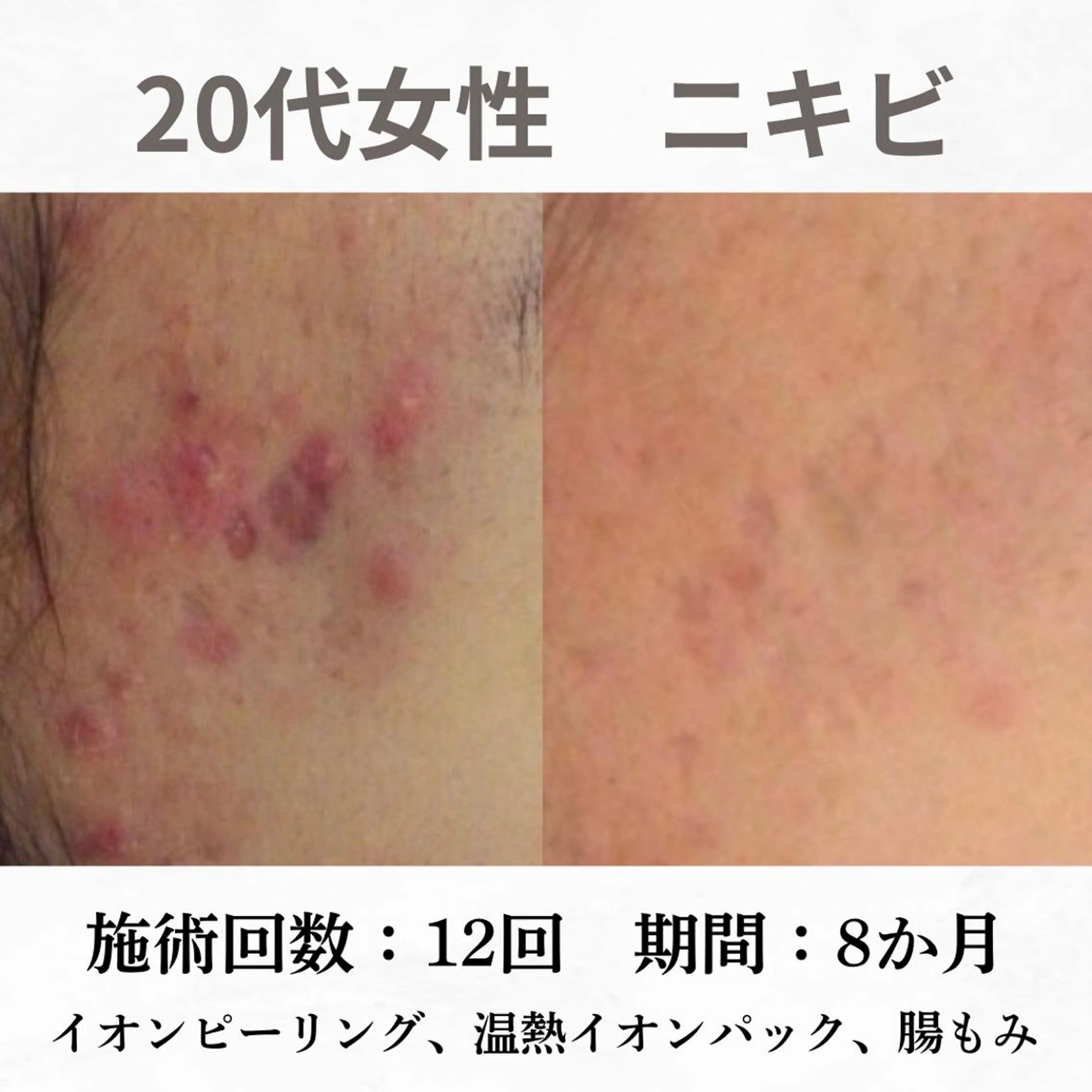 重度ニキビ専門🌷 ダウンタイムなしのエステ・リラクイメージ