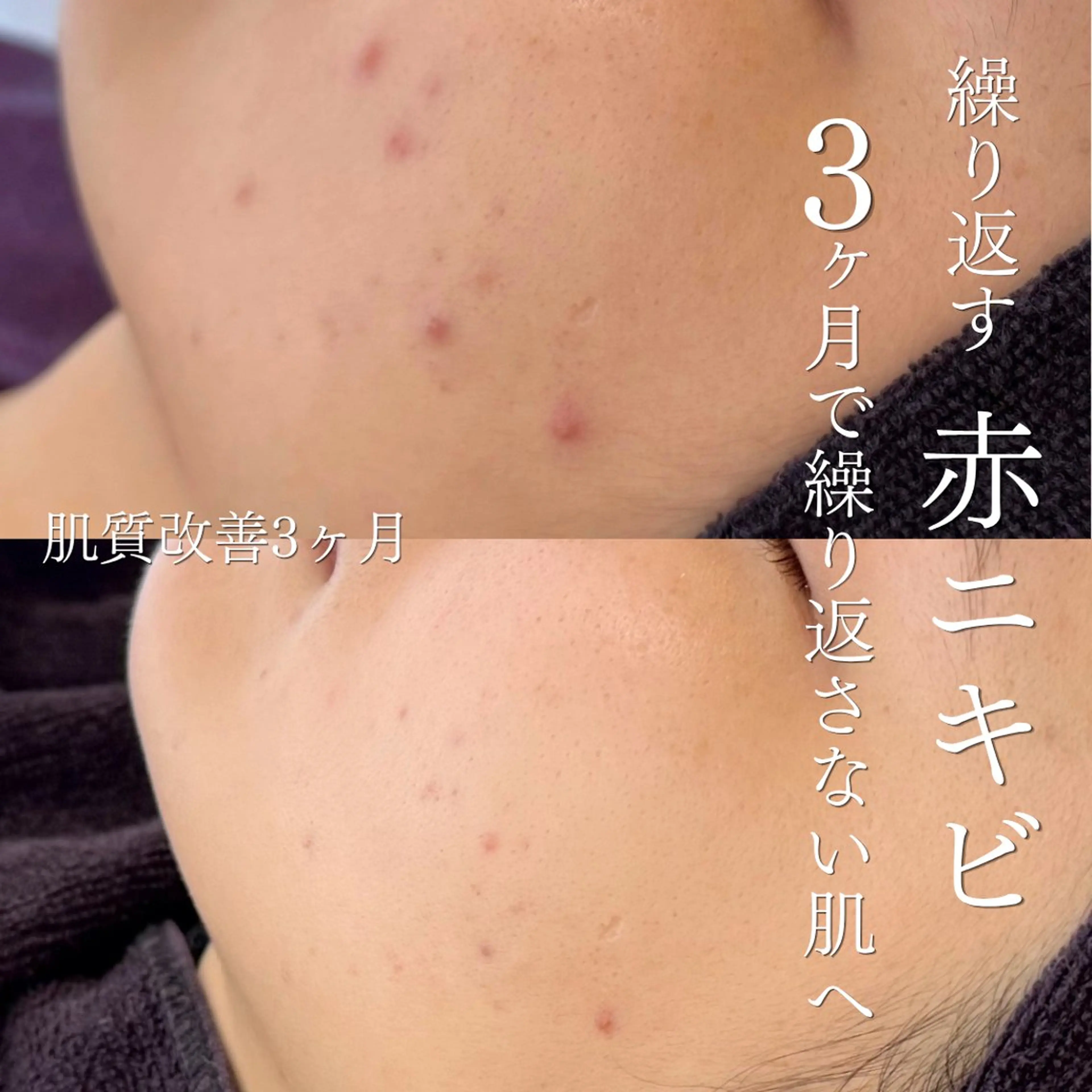 【57%OFF🌟3ヶ月症例モニター募集】繰り返すニキビ・乾燥に🫧クリスティーナ/ハーブピーリング/フェイシャルエステの写真