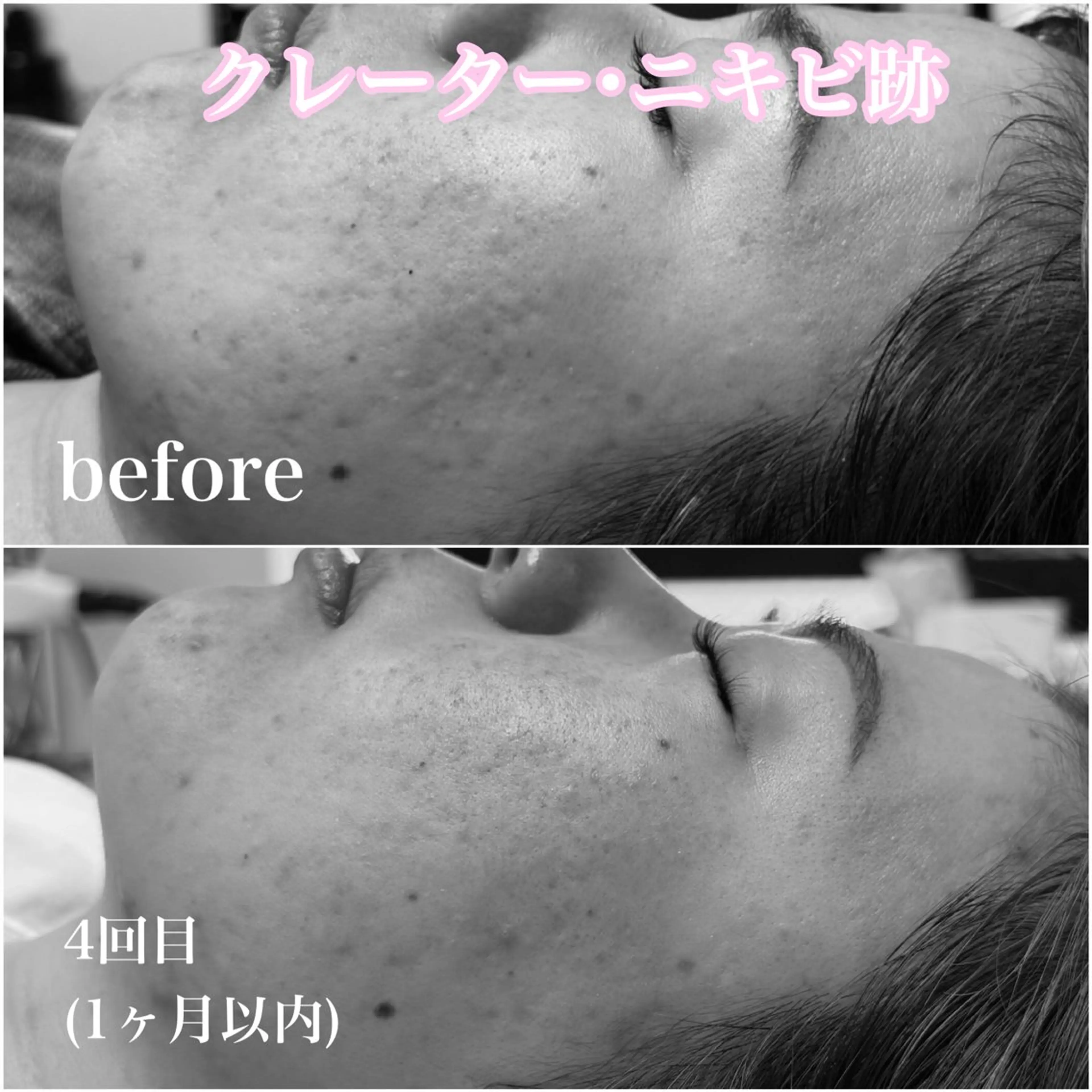 毛穴レス ハーブ＆ ワックス脱毛×光脱毛のエステ・リラクイメージ