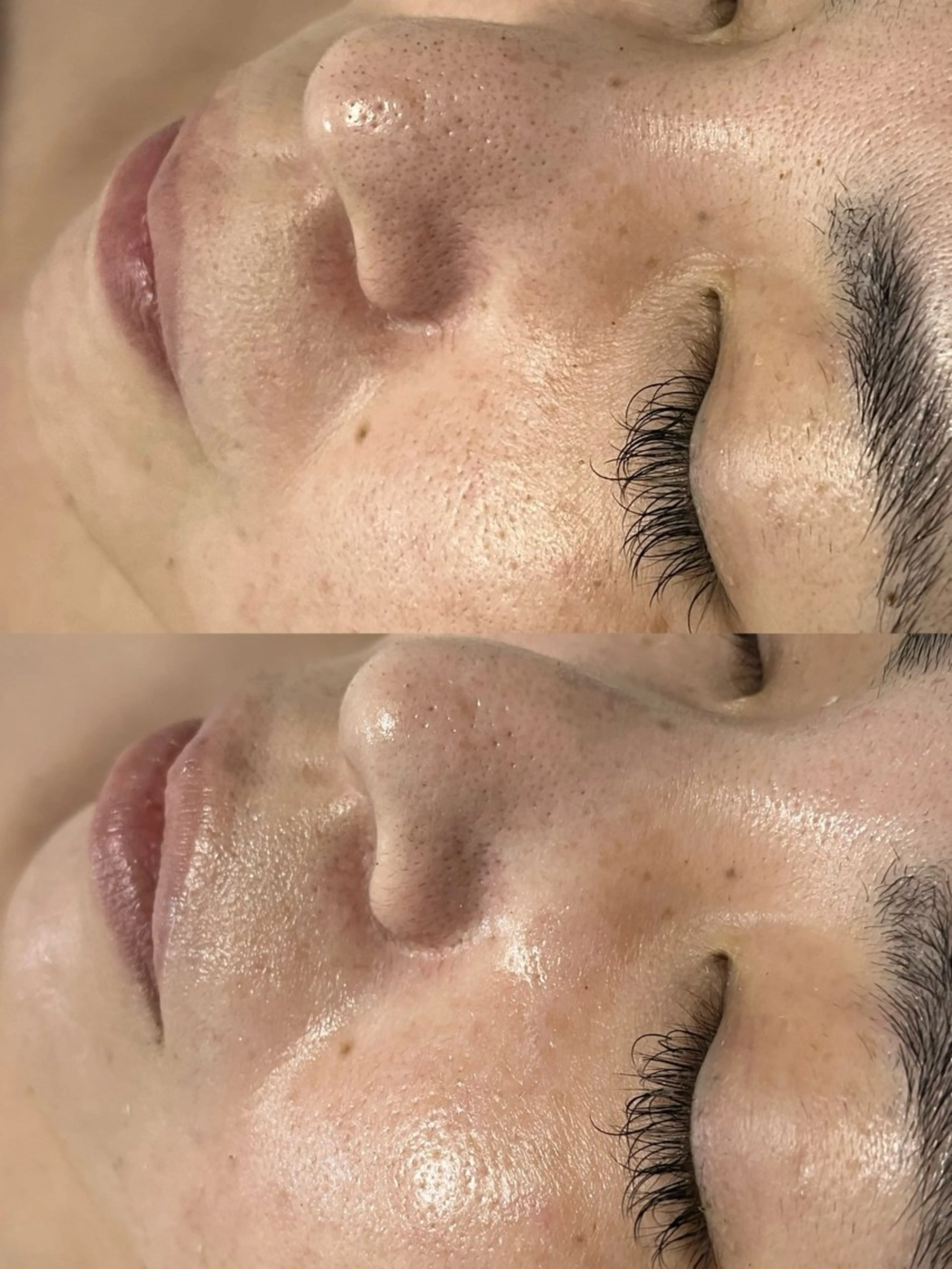 ニキビ／毛穴ケア ハーブピーリングのエステ・リラクイメージ