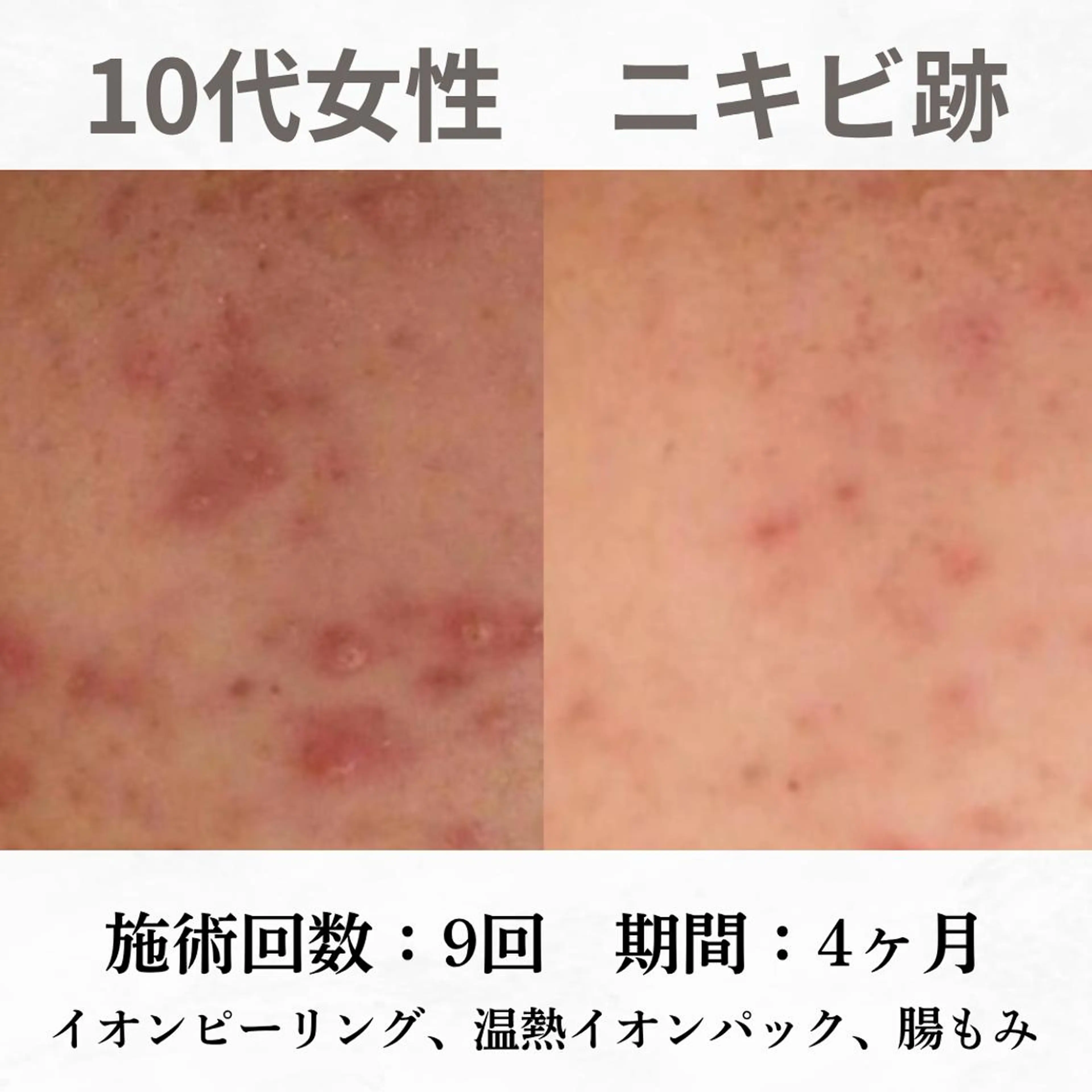 重度ニキビ専門🌷 ダウンタイムなしのエステ・リラクイメージ