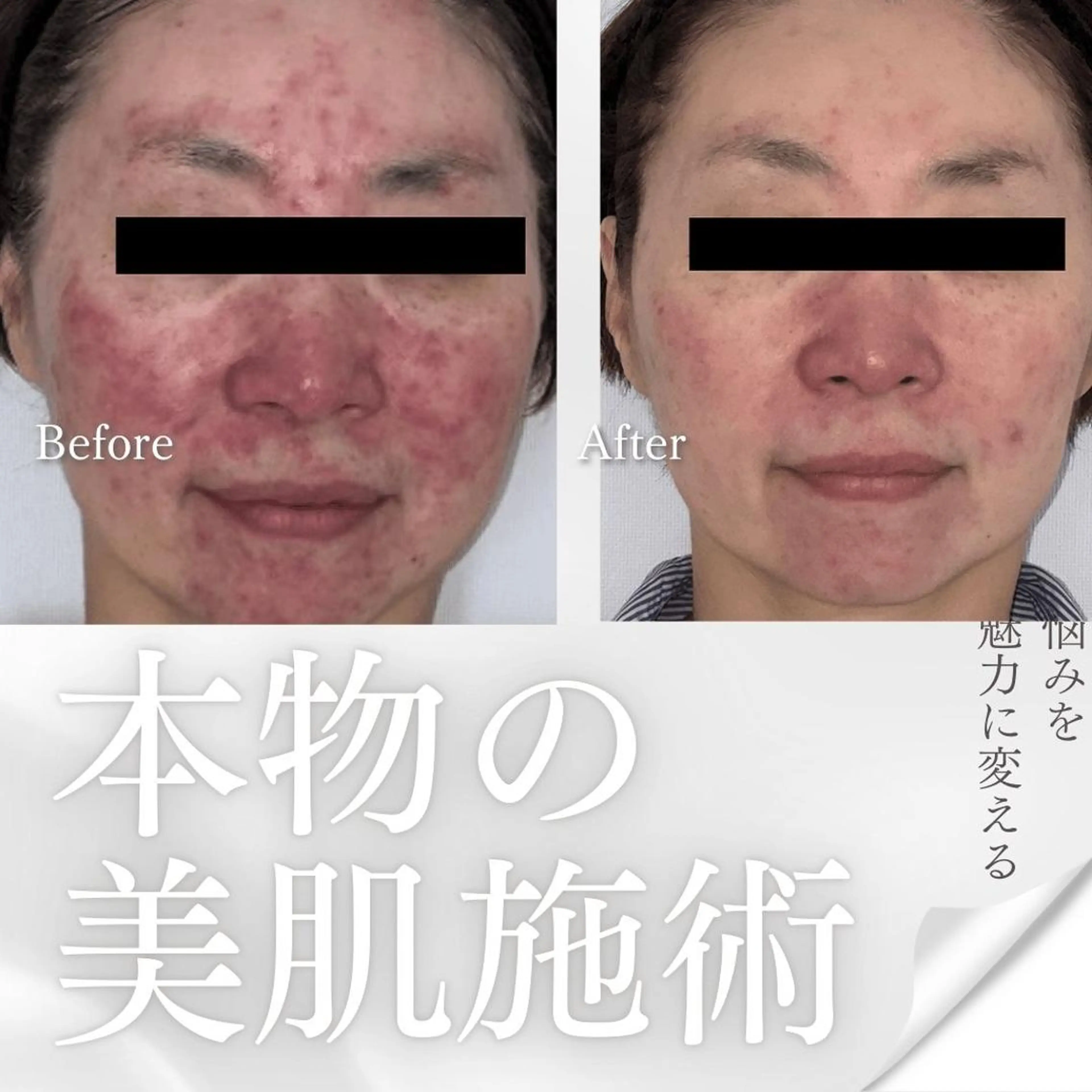 敏感肌、トラブルが出てしまったお肌、専用コースの写真