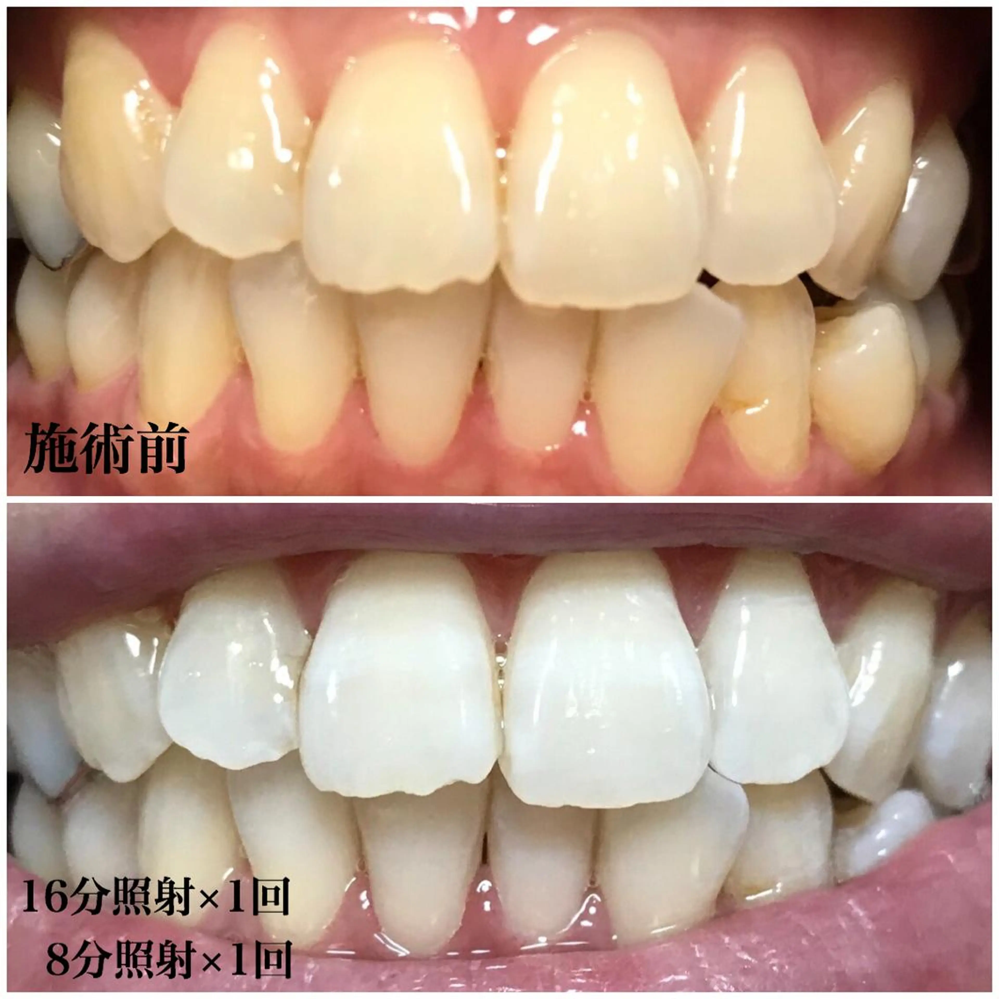 ネイル/耳つぼ /新ホワイトニングのネイルデザイン