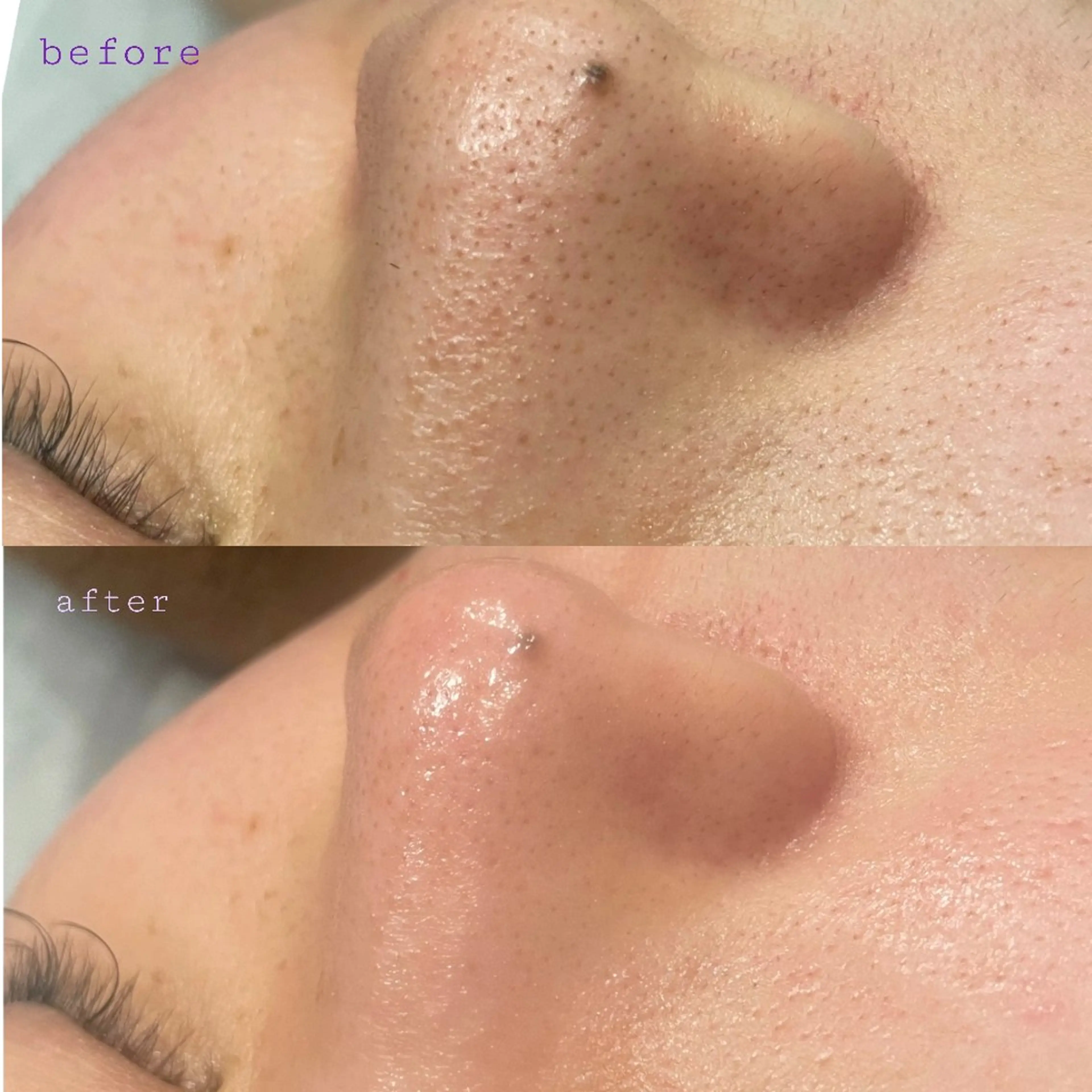 即効性◎お出かけ前に💠ハイドラ毛穴洗浄【角栓詰まり/黒ずみ/ざらつき/くすみ】の写真