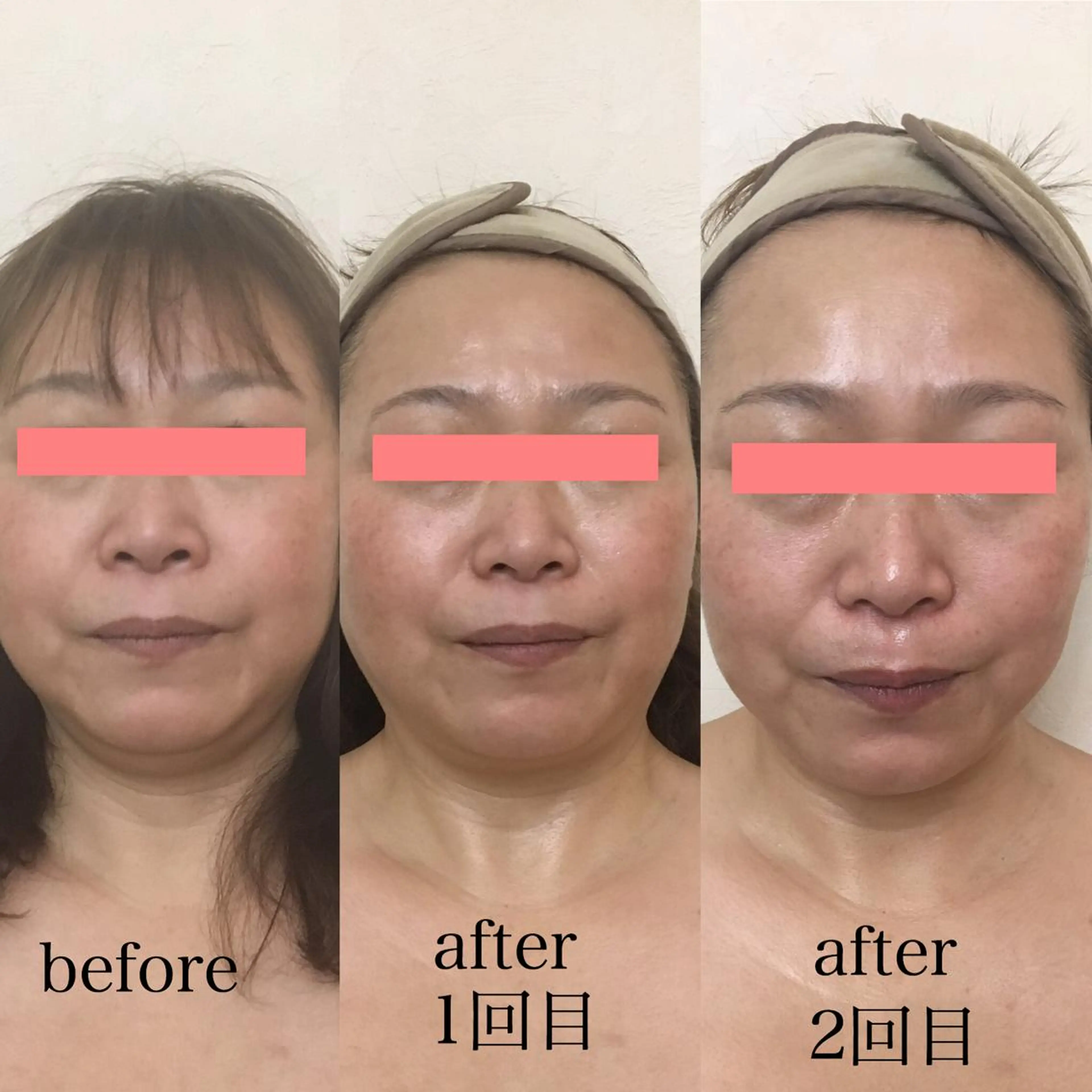 最高級小顔シワ伸ばしエステ！！二重アゴ撃退！ラジオ派＋高周波最新技術の写真
