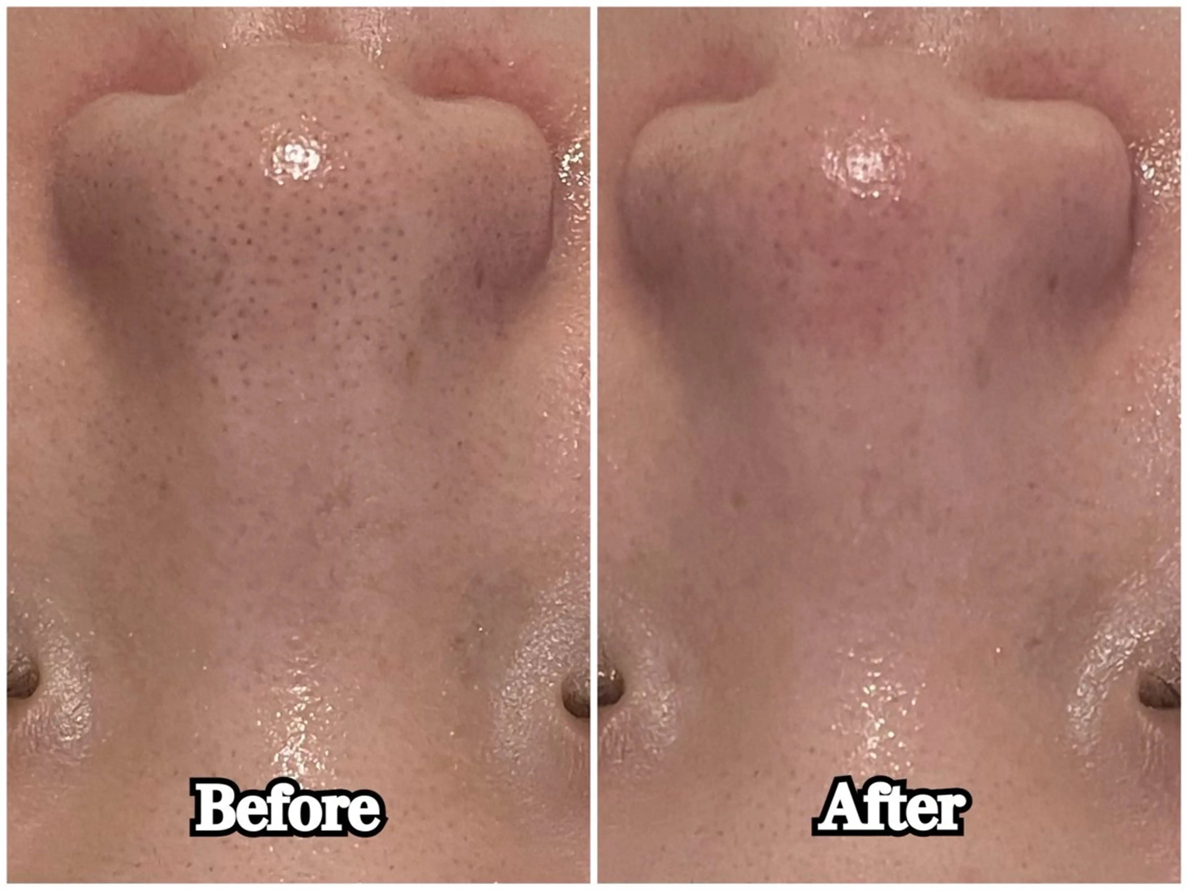 【毛穴詰まり・黒ずみ撃退！】韓国式毛穴洗浄🫧ハイドロフェイシャル ✨の写真