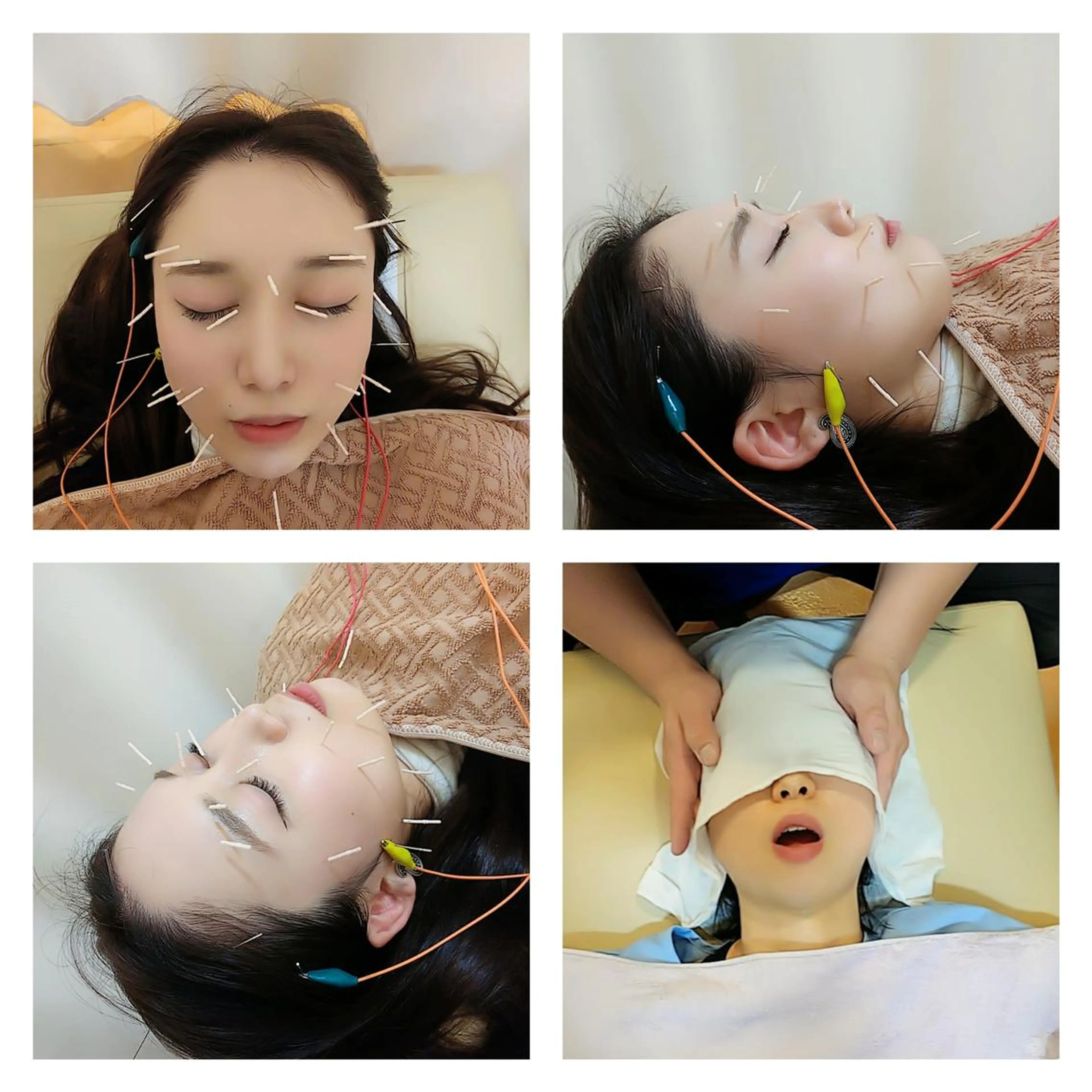 リフトアップ・たるみ ☆美容鍼小顔矯正のその他イメージ