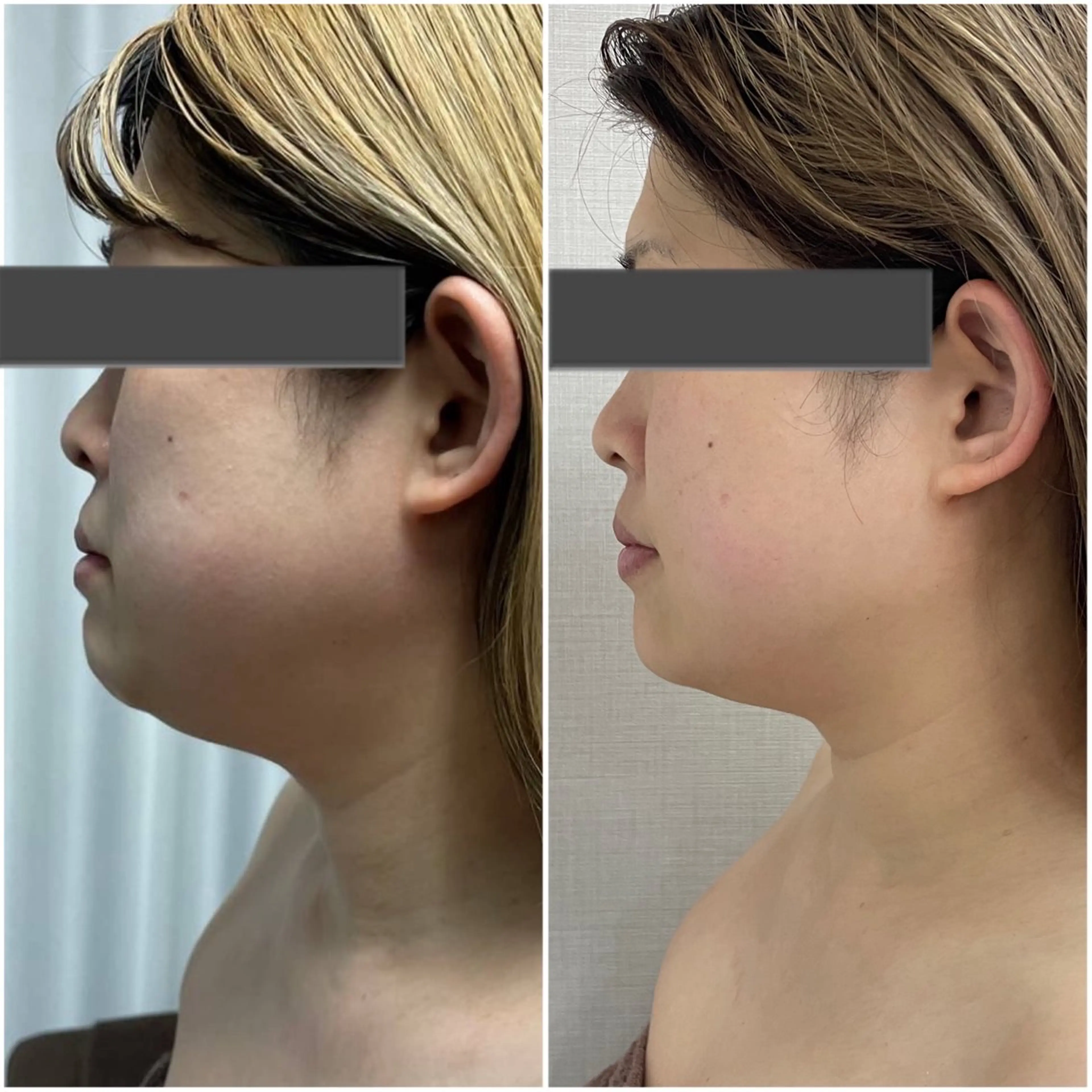 期間限定！先着20名様】究極小顔(マシン×小顔矯正)90min￥18,700→￥1,000の写真