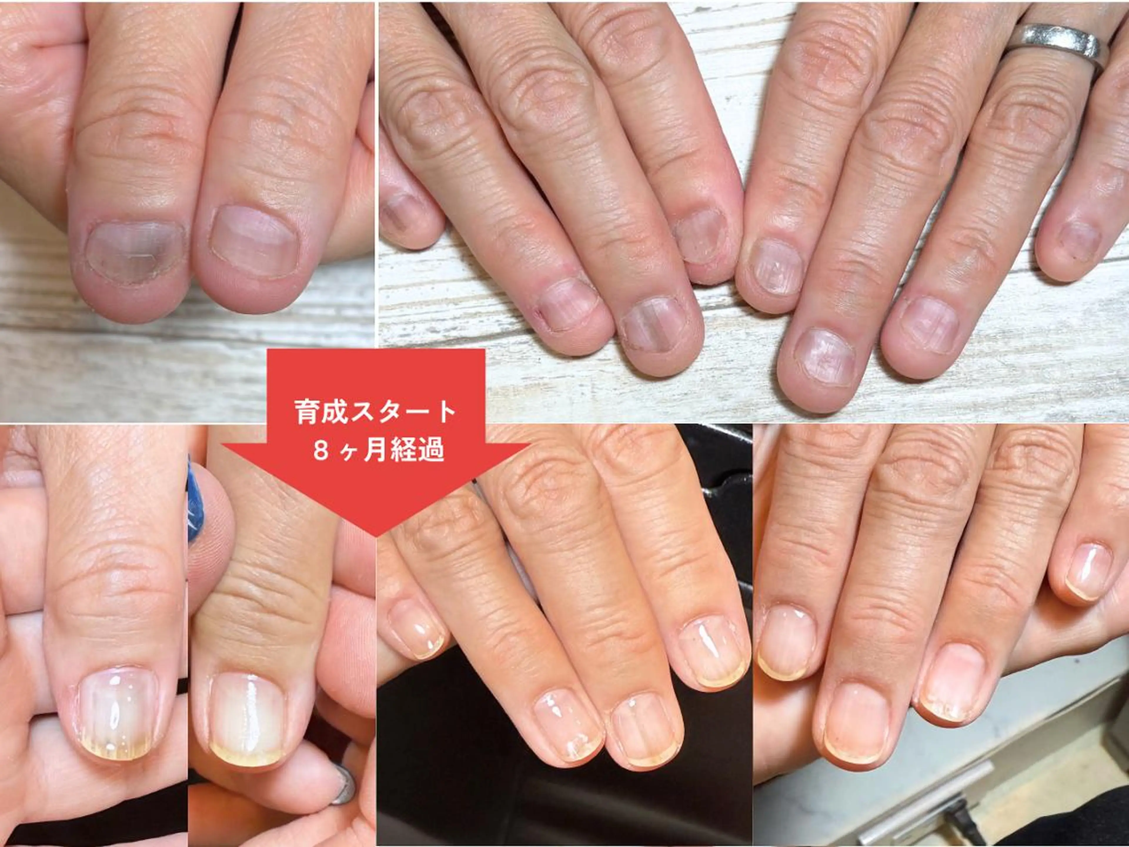 ネイル 深爪矯正・自爪育成 ネイルサロンアモまいのネイルデザイン