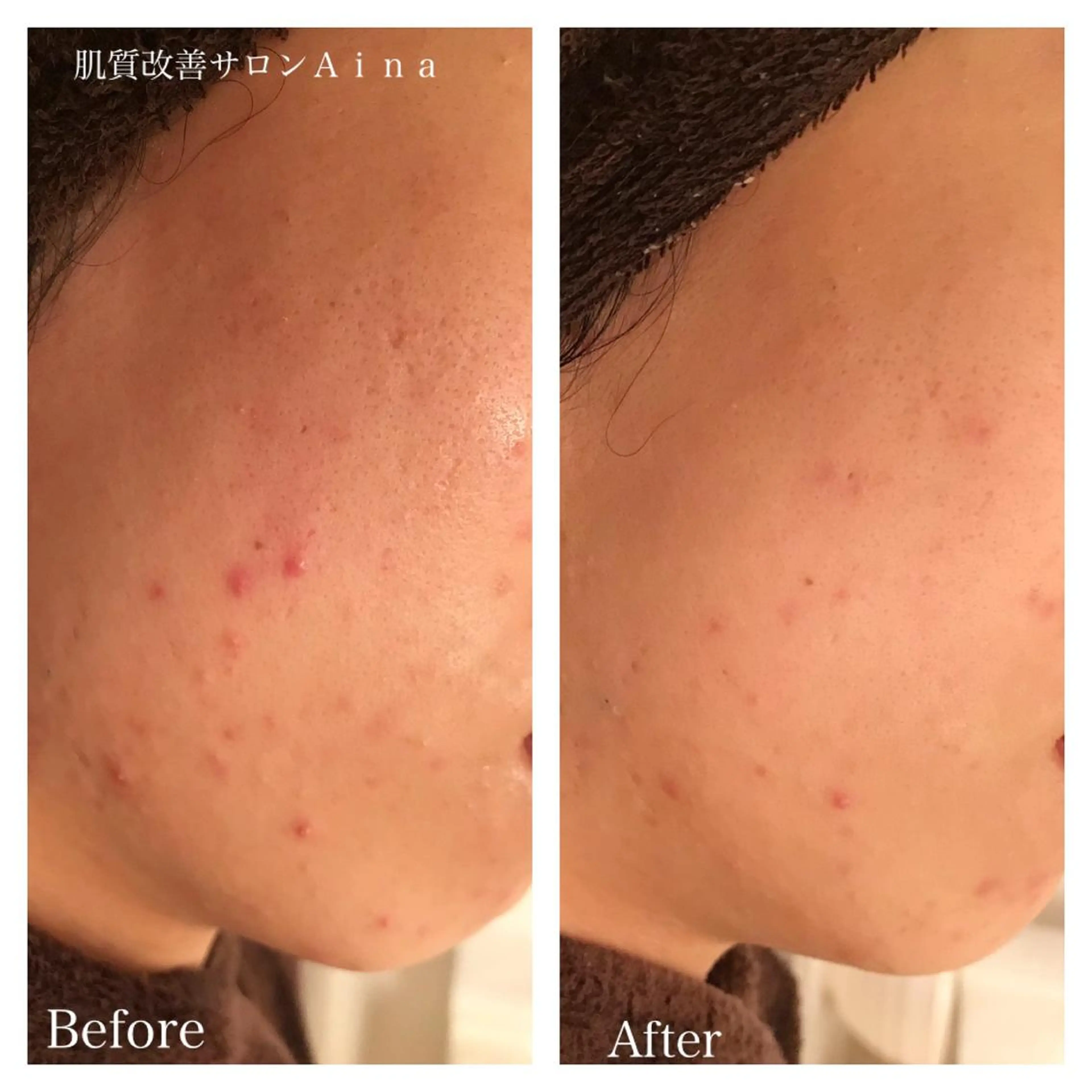 セミロング カラー パーマ ヘアアレンジ キッズ ネイル マツエク・マツパ 卒業式のヘアスタイル 卒業式 赤色 エステ リラク ニキビ跡専門サロン Ａｉｎａのエステ・リラクイメージ