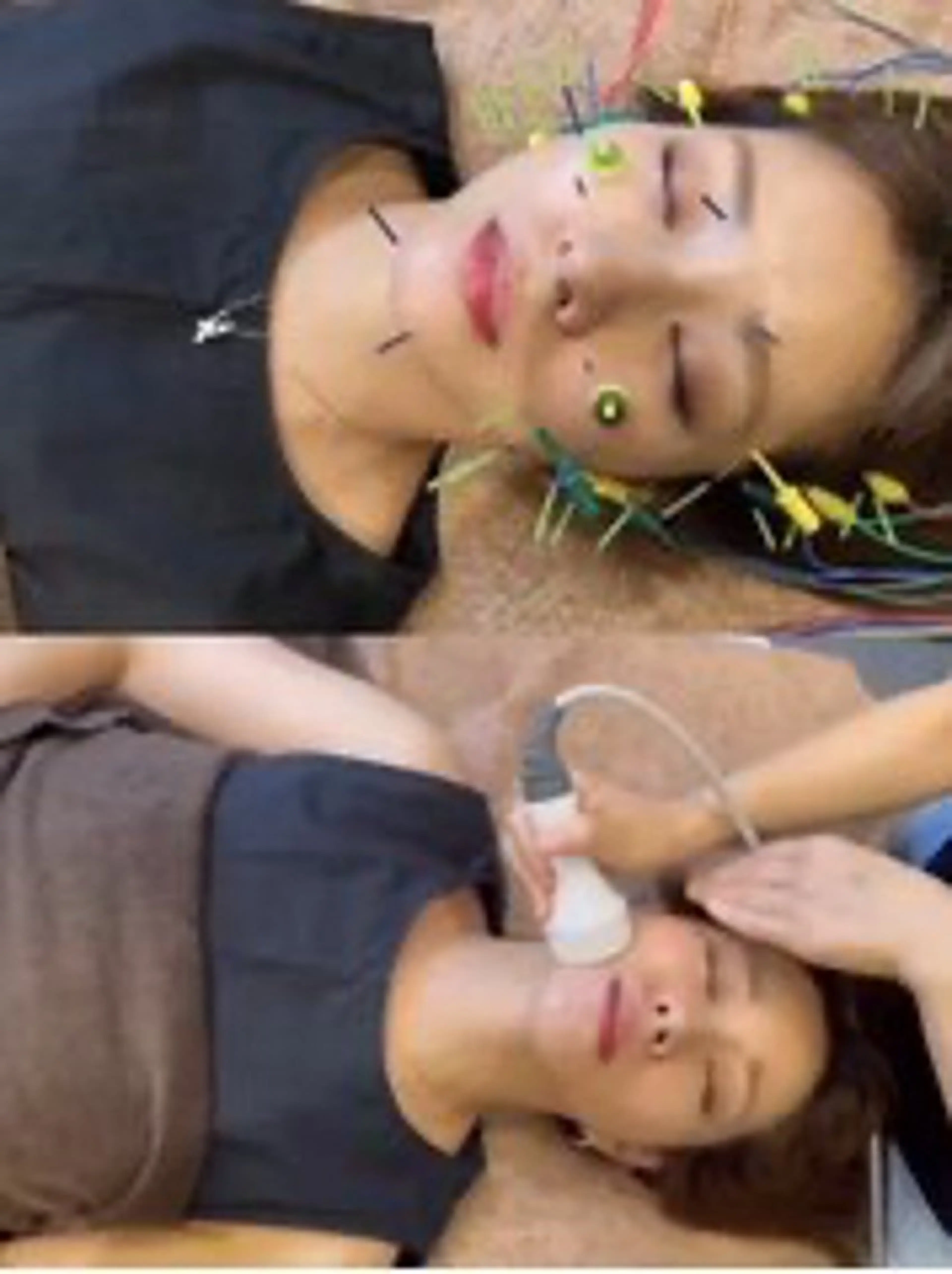 ✨人気No.１✨浮腫をスッキリ小顔に👩【電気美容鍼＋強力EMS高周波】☝️嬉しい頭首マッサージ付😆❣️の写真