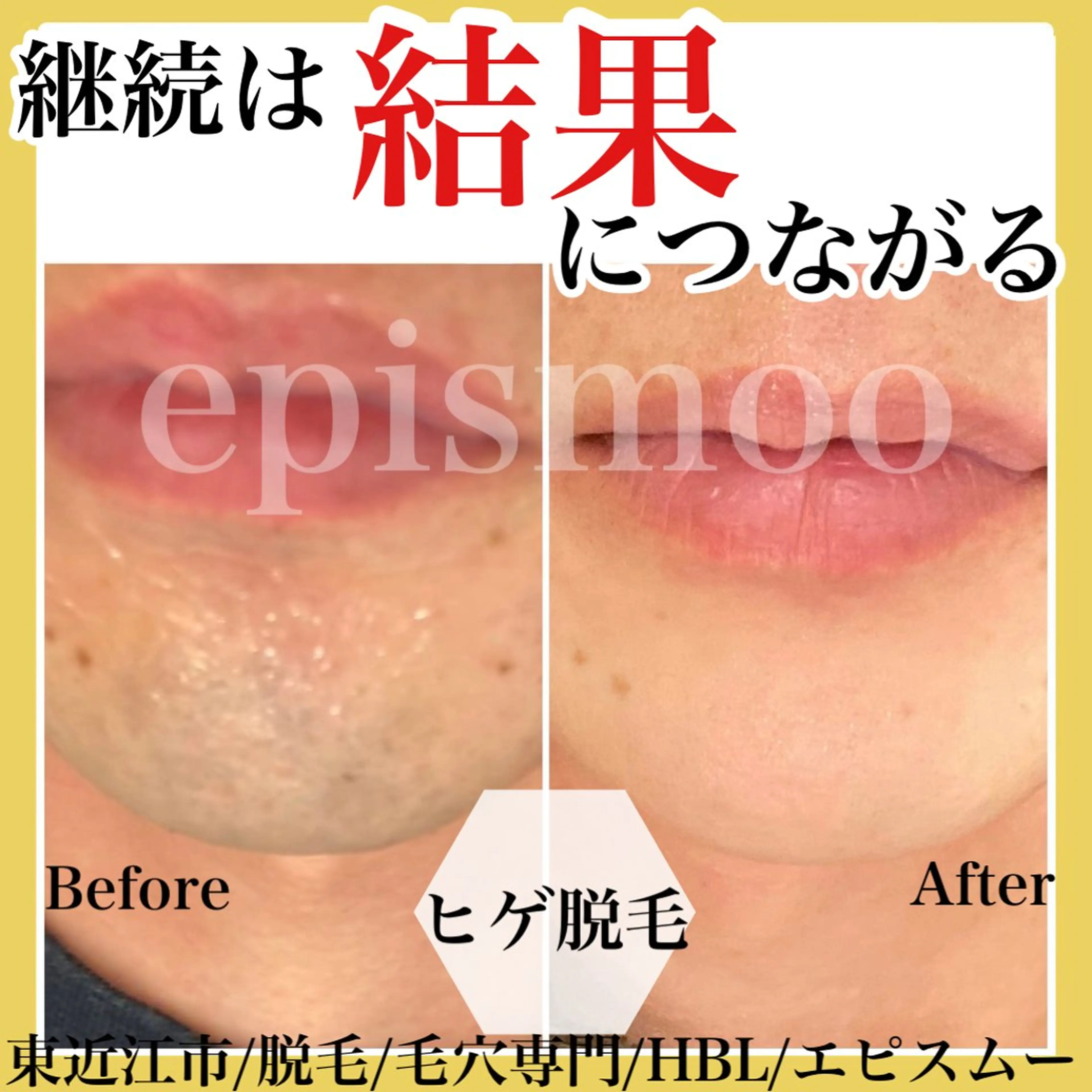 メンズ 脱毛 epismoo 脱毛/HBL/毛穴の眉毛・アイブロウイメージ