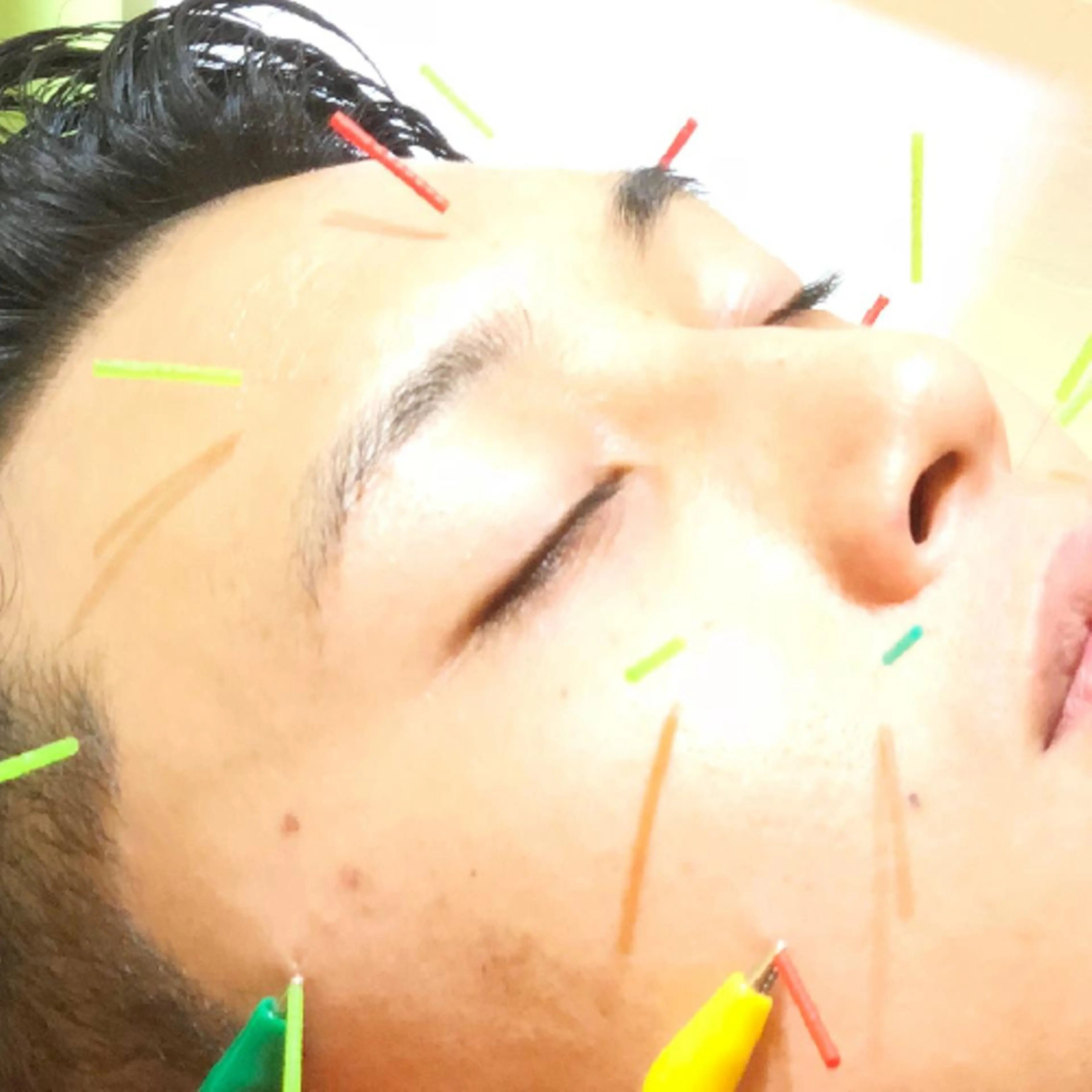 🌈リフトUP美容鍼 🙌 オオシマ🌈のエステ・リラクイメージ