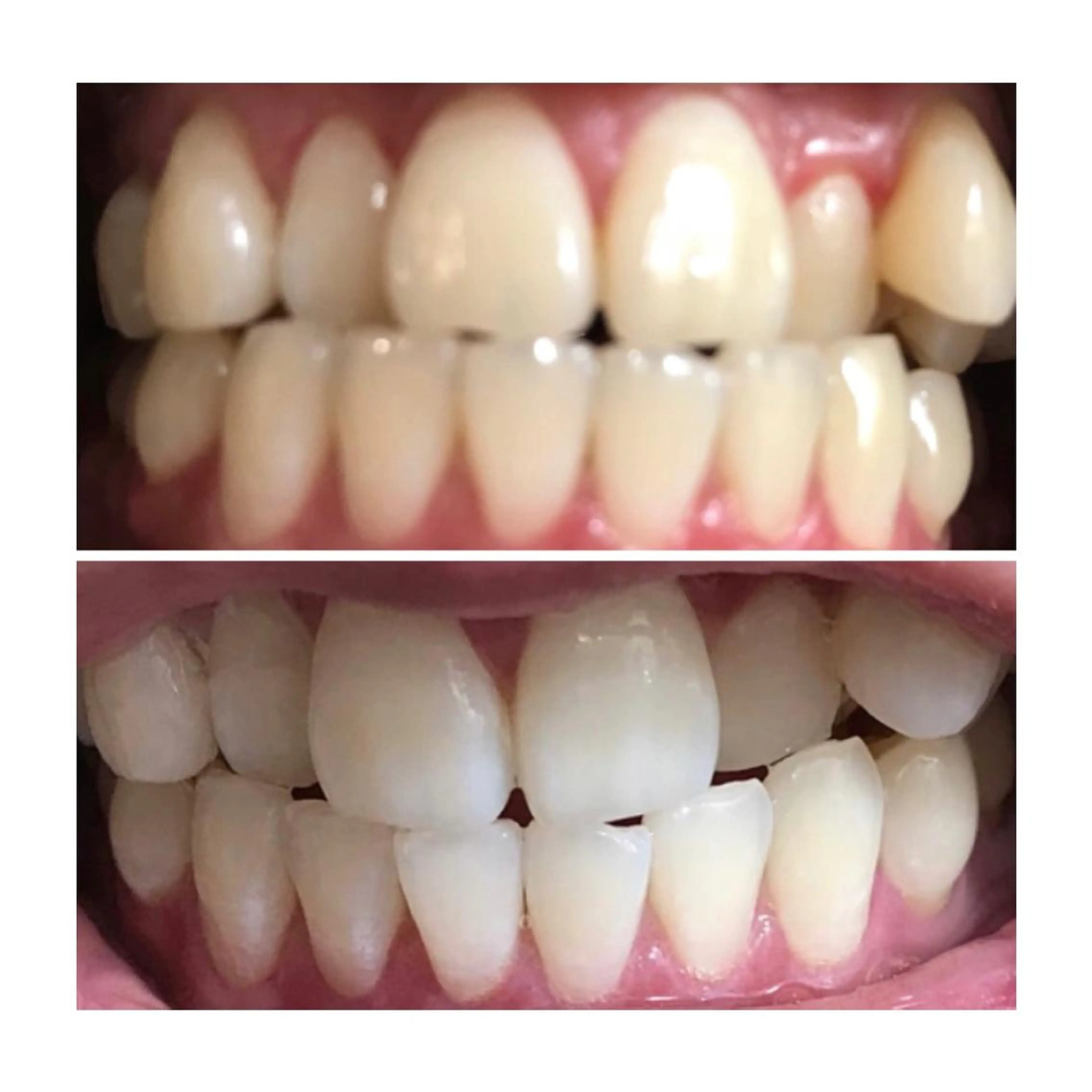 【minimo限定】ハイグレードホワイトニング🦷8分4回照射　結果が目に見える💯の写真