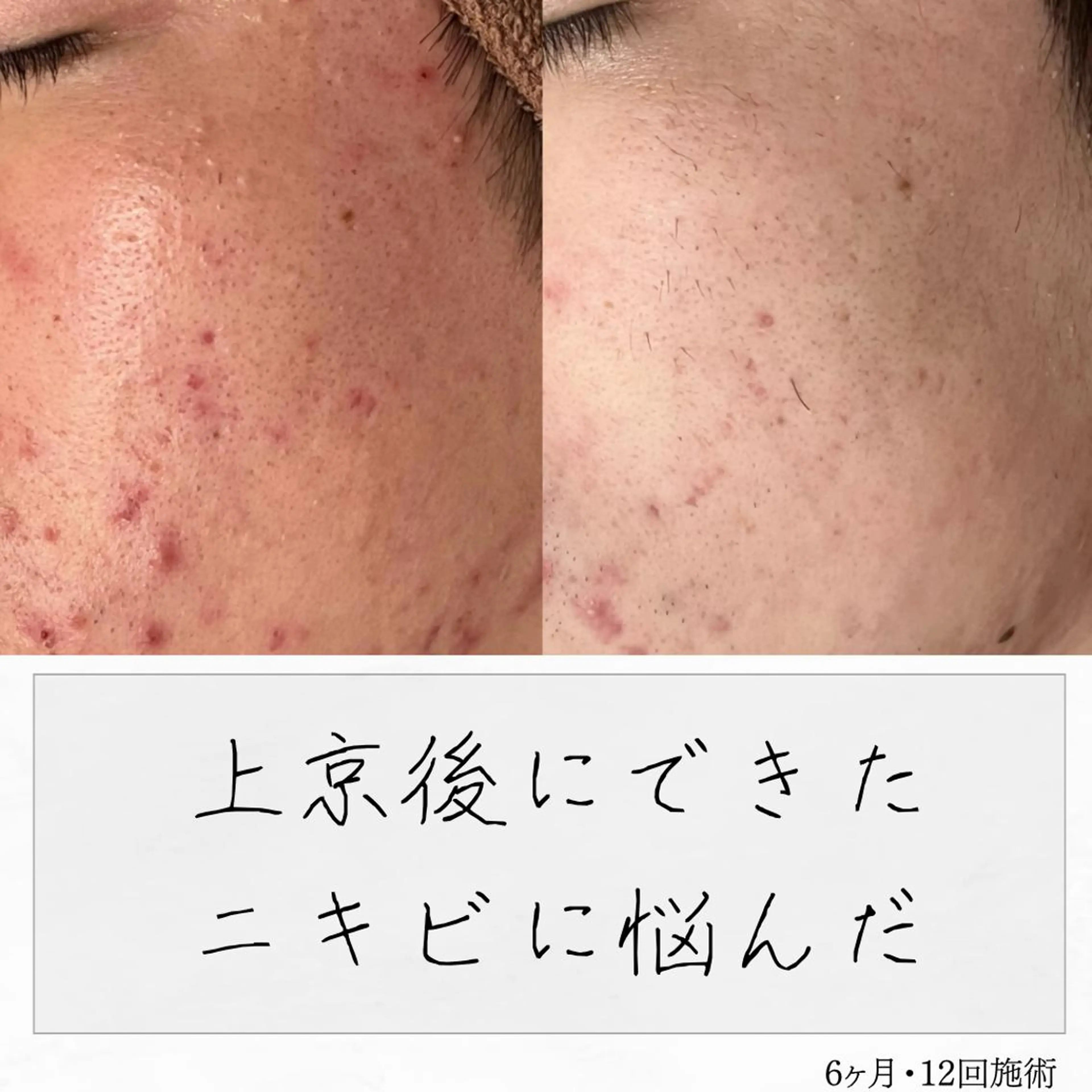 ニキビ経験者が施術 する専門サロン🌻のエステ・リラクイメージ