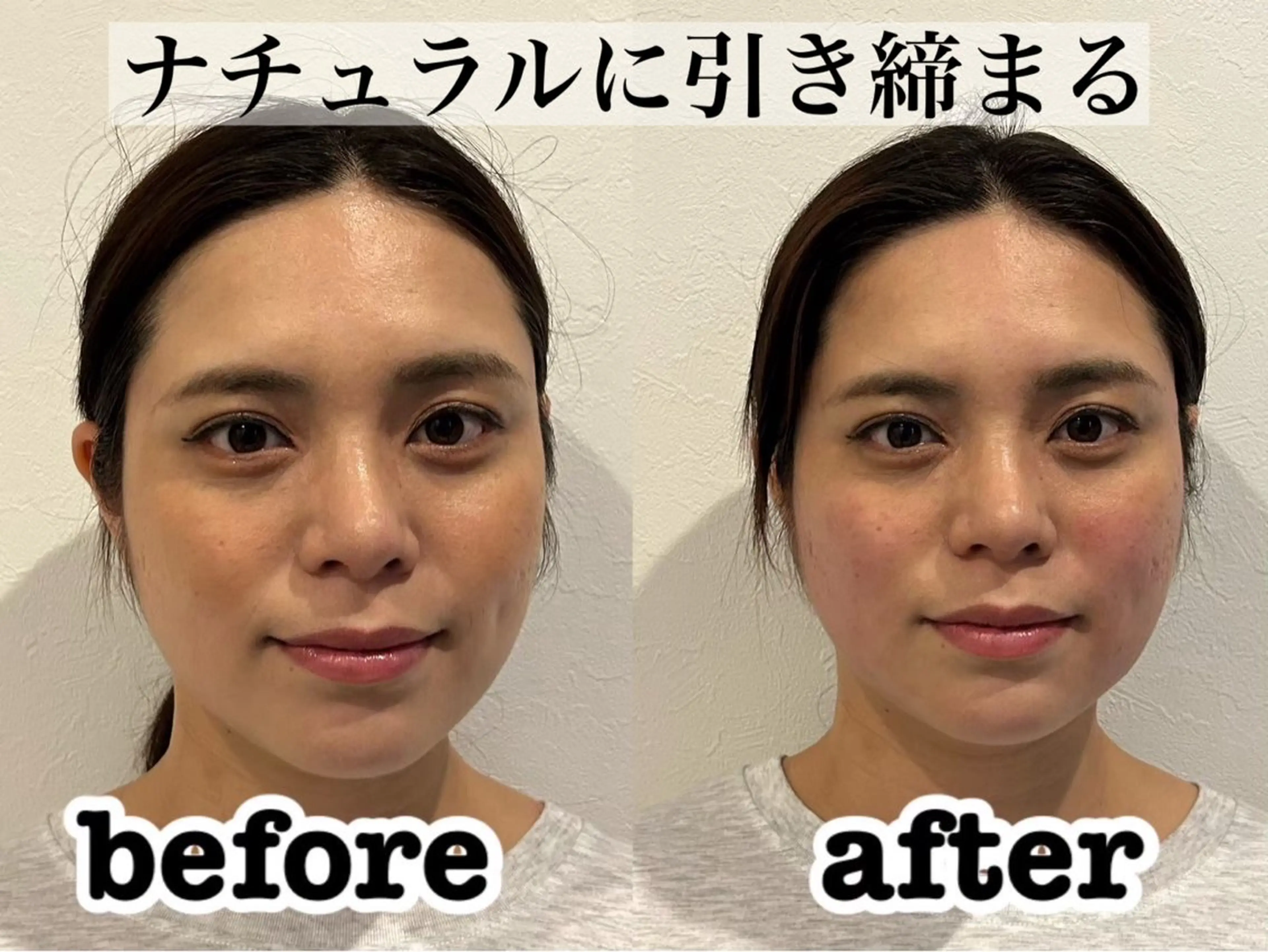 エステ リラク 肌質改善×美容鍼 ゆいのエステ・リラクイメージ