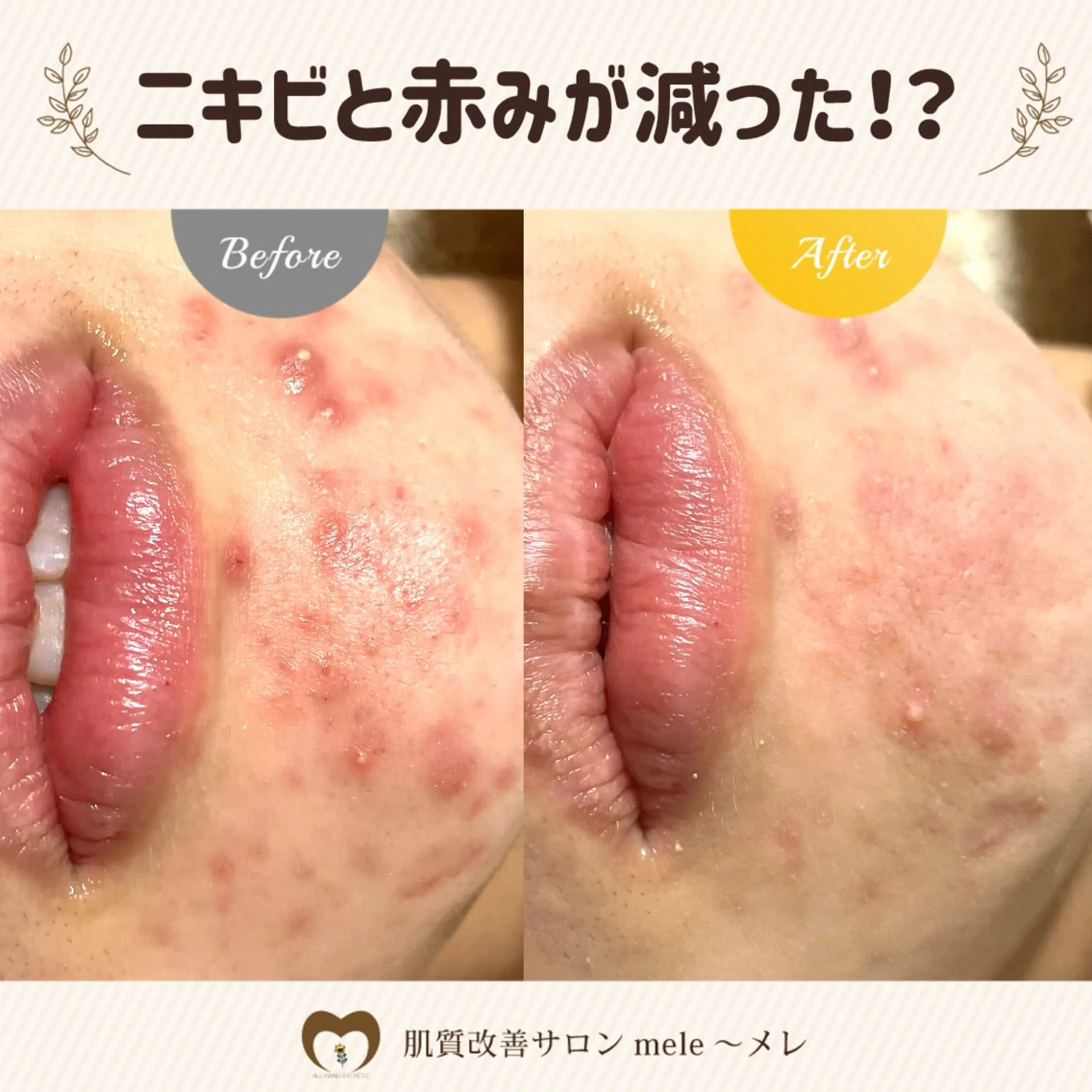 繰り返すニキビ・毛穴 ✨つくば肌質改善専門のエステ・リラクイメージ