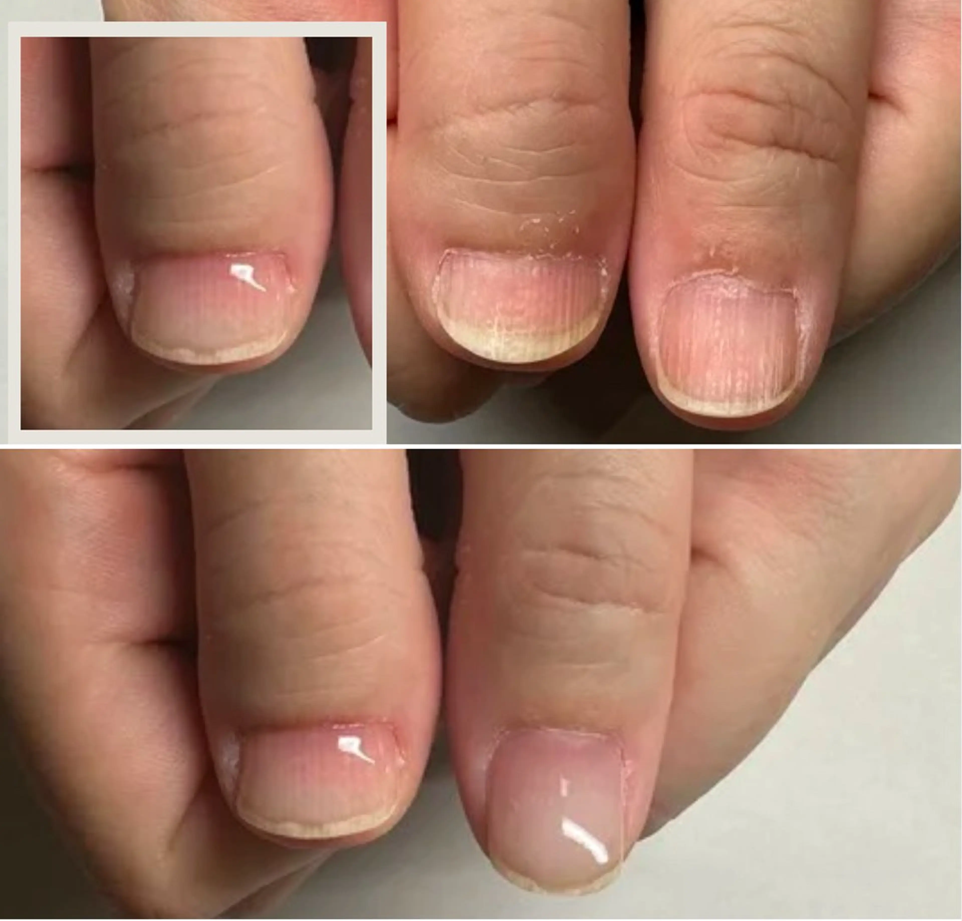 ネイル 深爪矯正専門店 ネイルサロンKUUのネイルデザイン