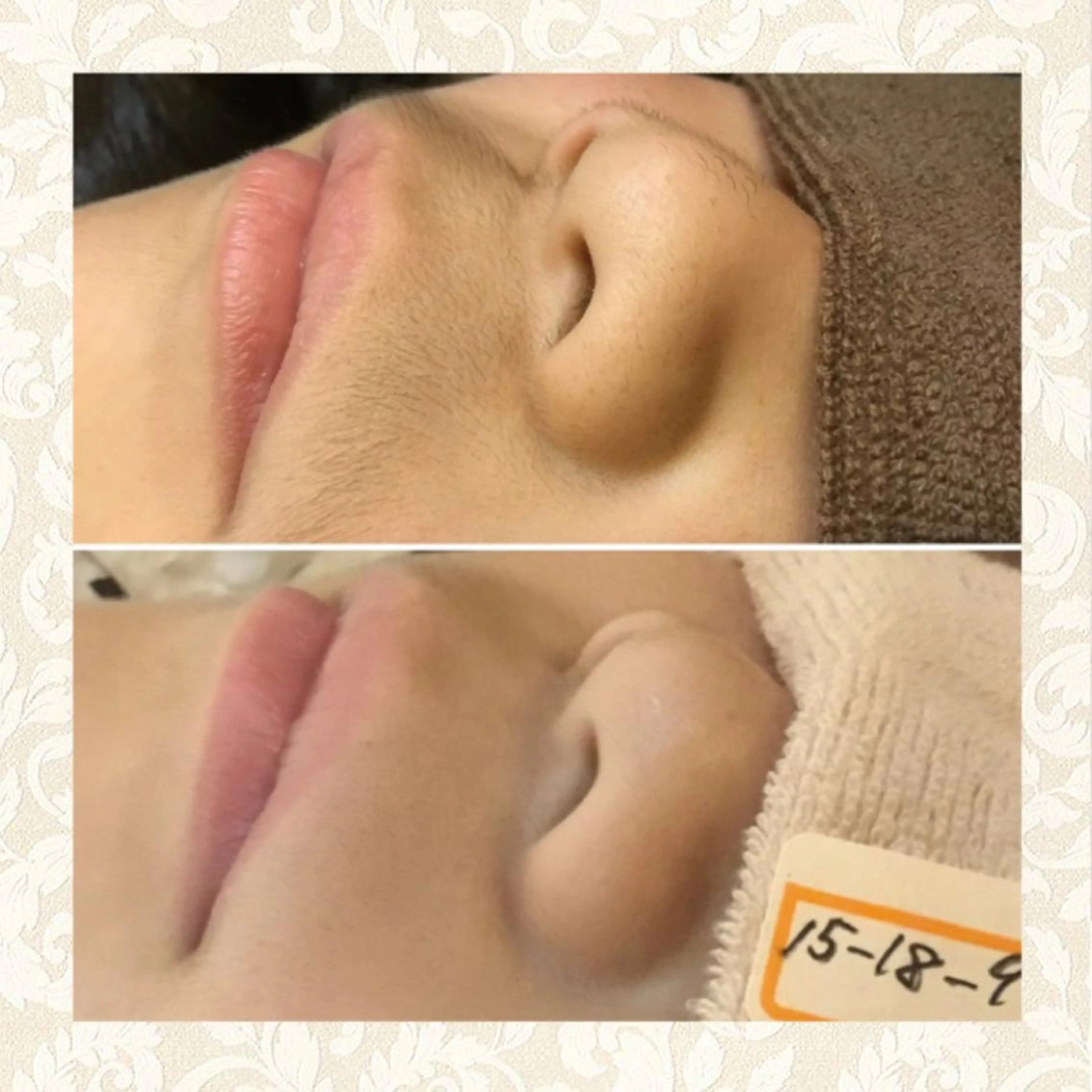 【お顔パーツ脱毛♪】鼻下脱毛体験の写真