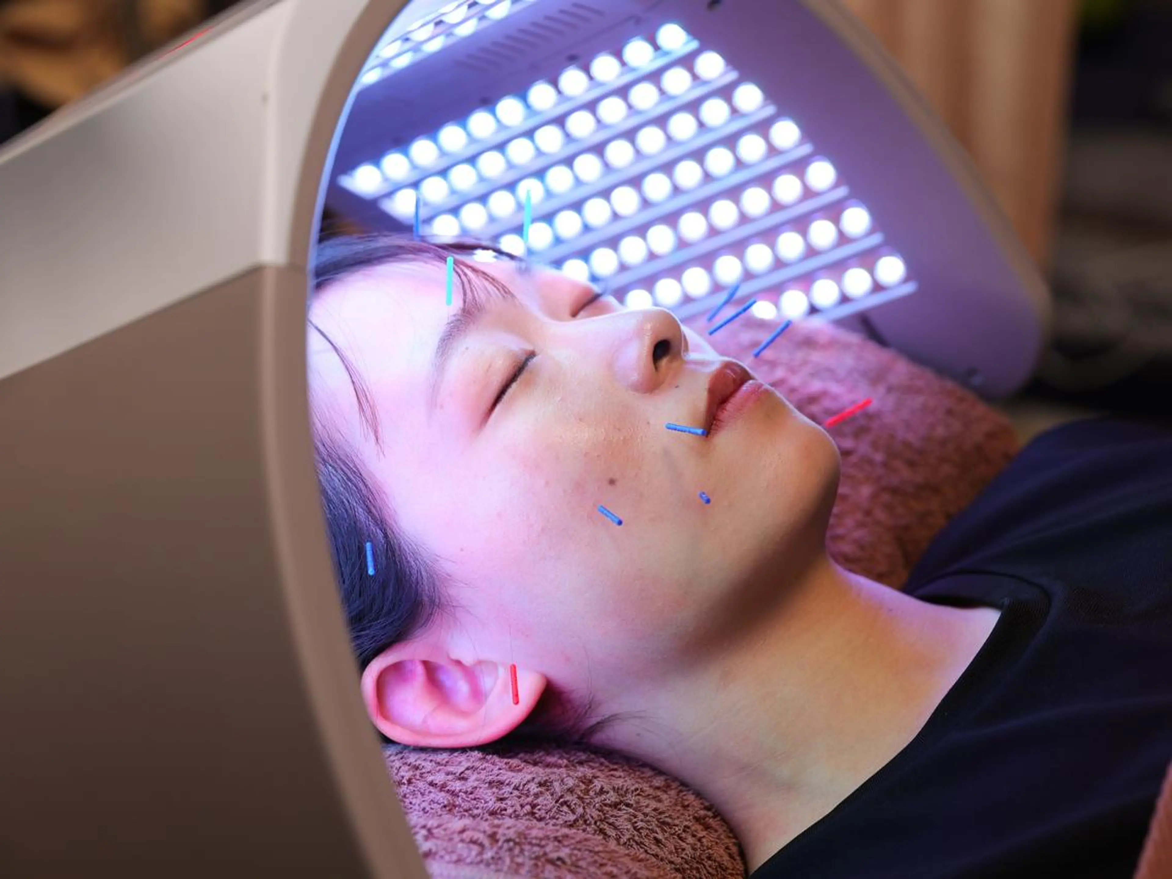 【顔出しOKの女性限定】モニター募集（美容鍼＋鍼通電＆光エステ、首・肩のほぐし有）※毎月先着１名の写真