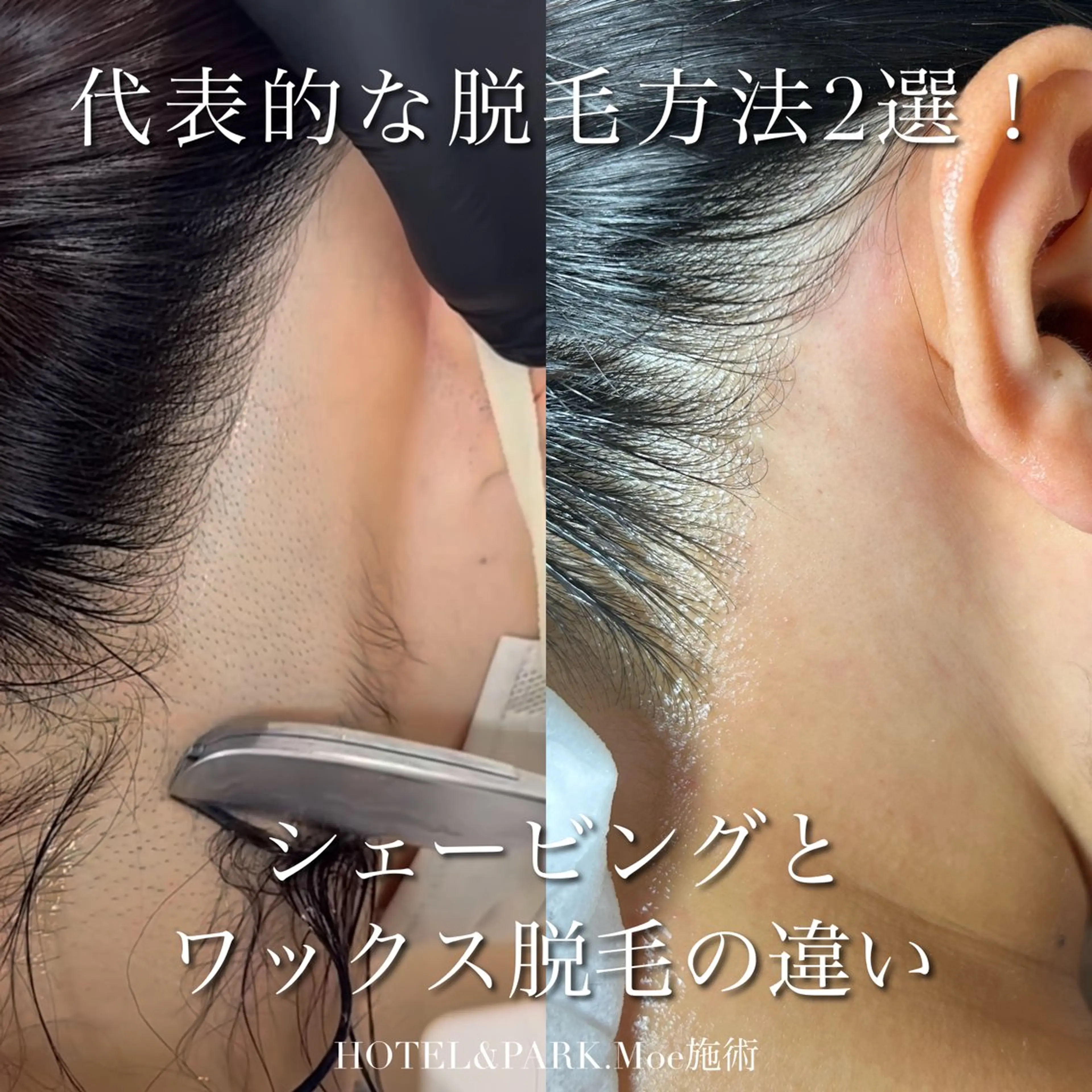 脱毛 HOTEL&PARK .Moeワックス脱毛のエステ・リラクイメージ
