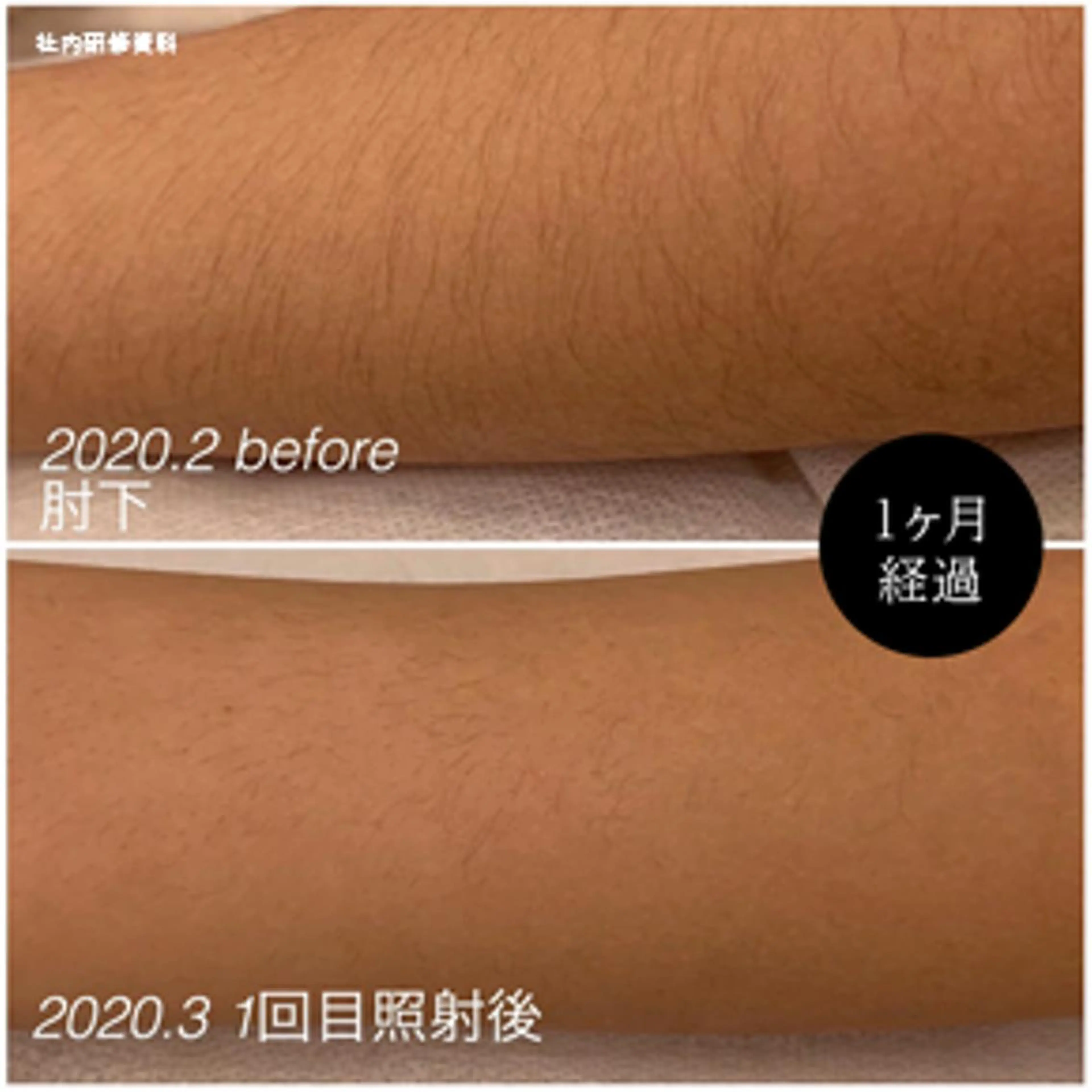 【メンズ脱毛】　両ウデ　￥2200の写真