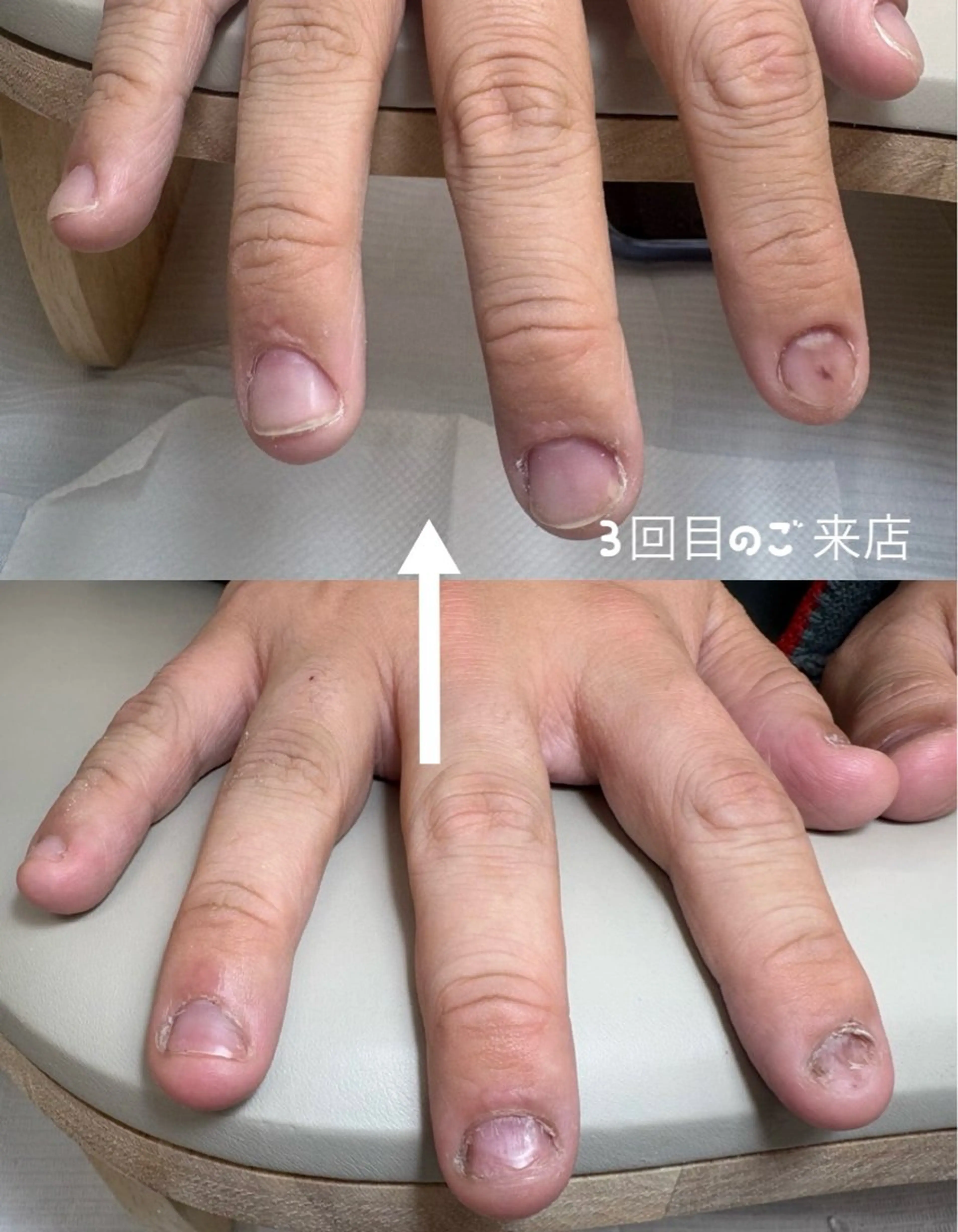 綺麗な縦長爪に✨自爪育成コース3回分🉐お渡し用オイル付き！深爪、噛み癖、貝爪の方もご相談🉑の写真