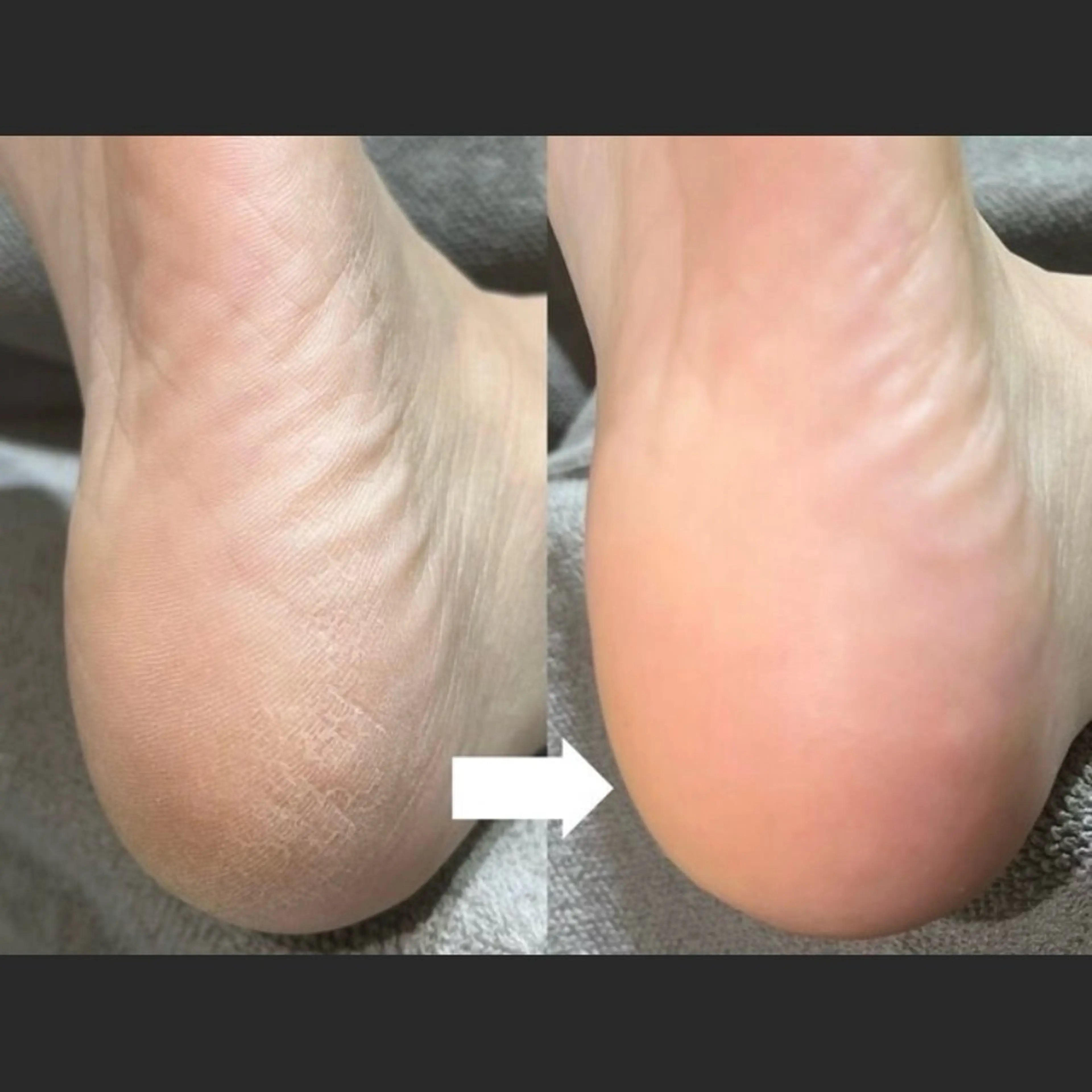 フットケア🦶ガサガサかかとに◆フットスパ¥3500  ※角質除去のみ¥2200の写真