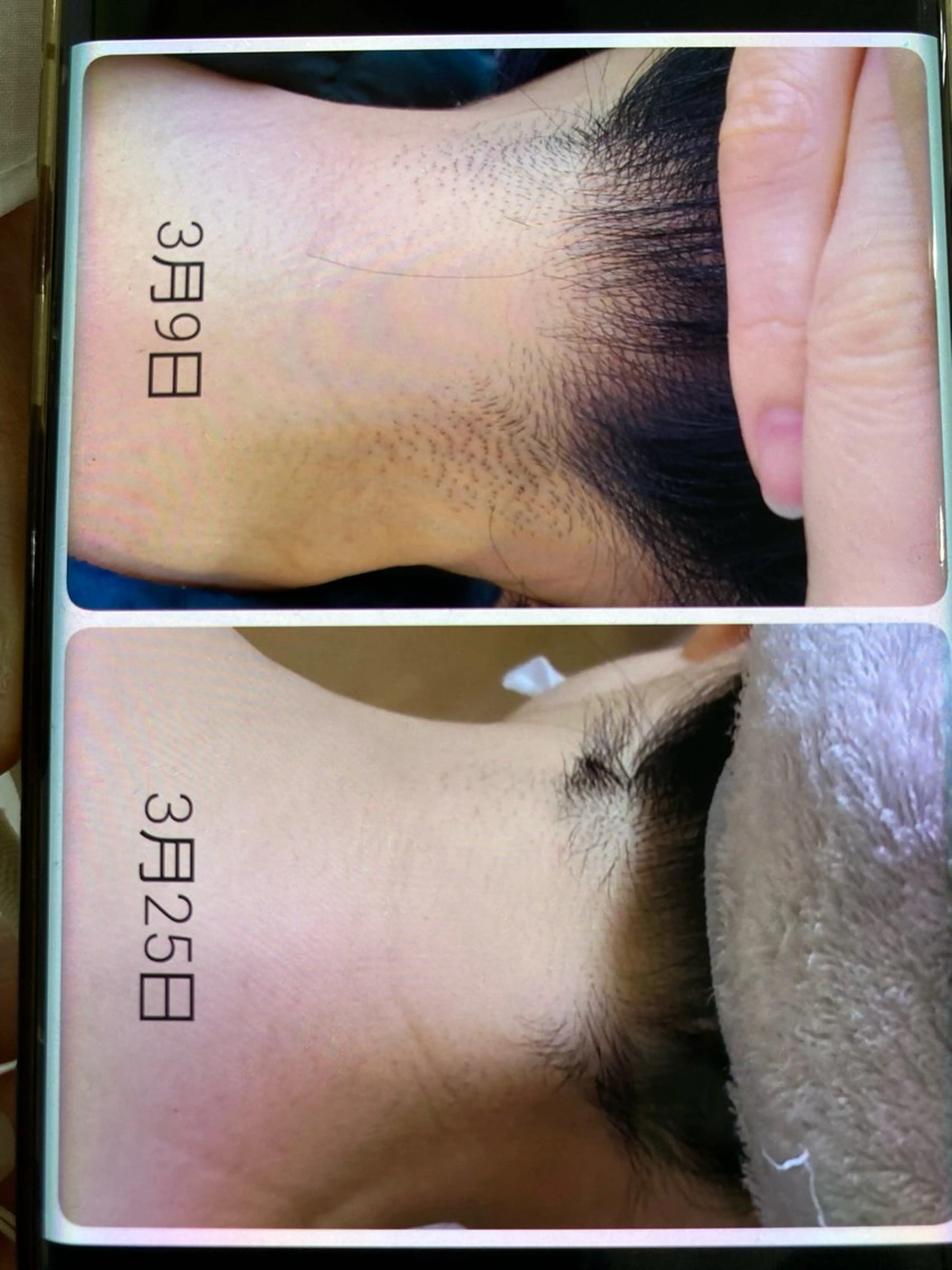 うなじヒカリ脱毛2750円の写真