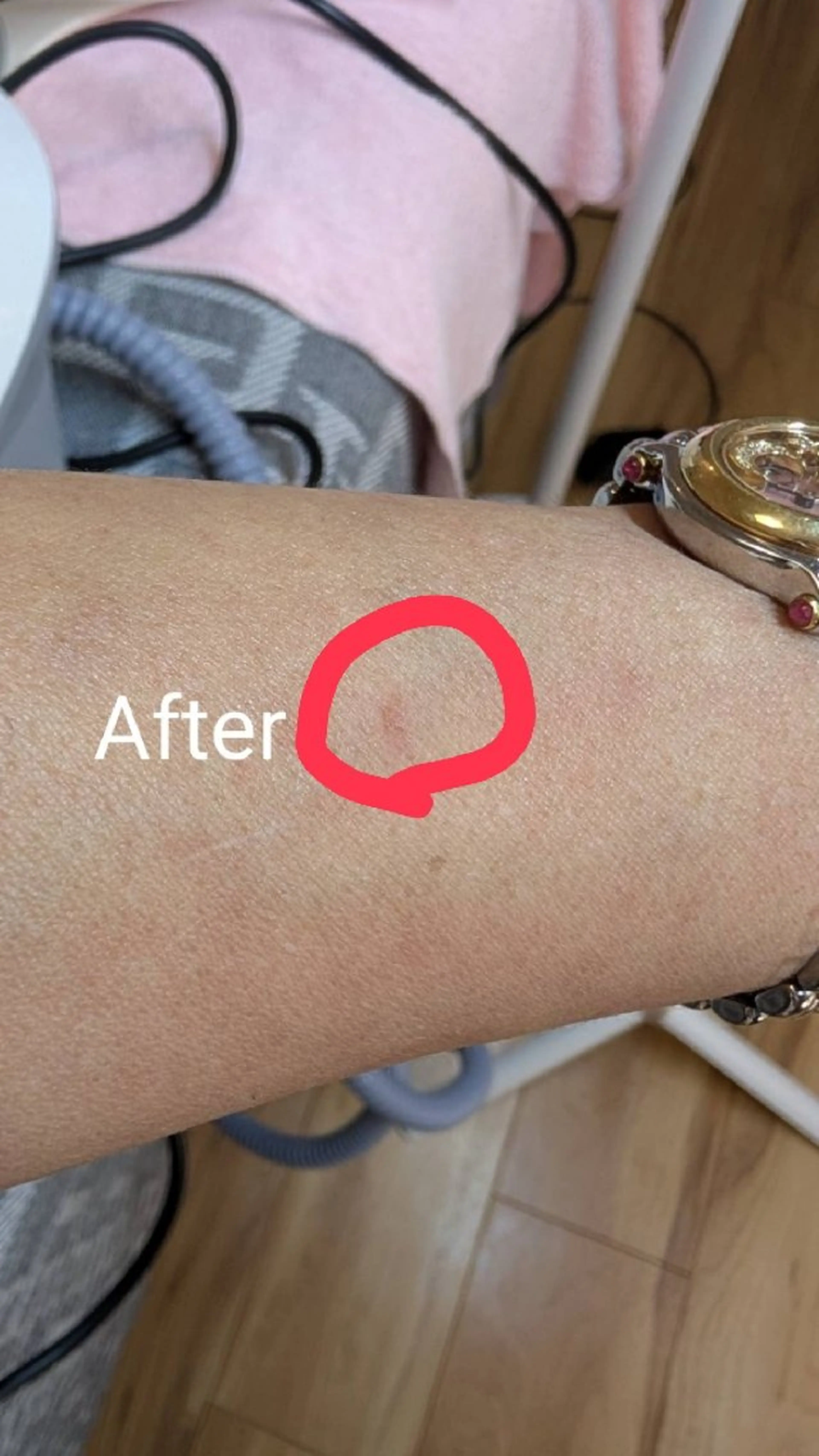 シミ退治！シミケア！シミ消し！　ヤバシ💦消えた🙀1ヶ月限定物価高騰支援価格の写真