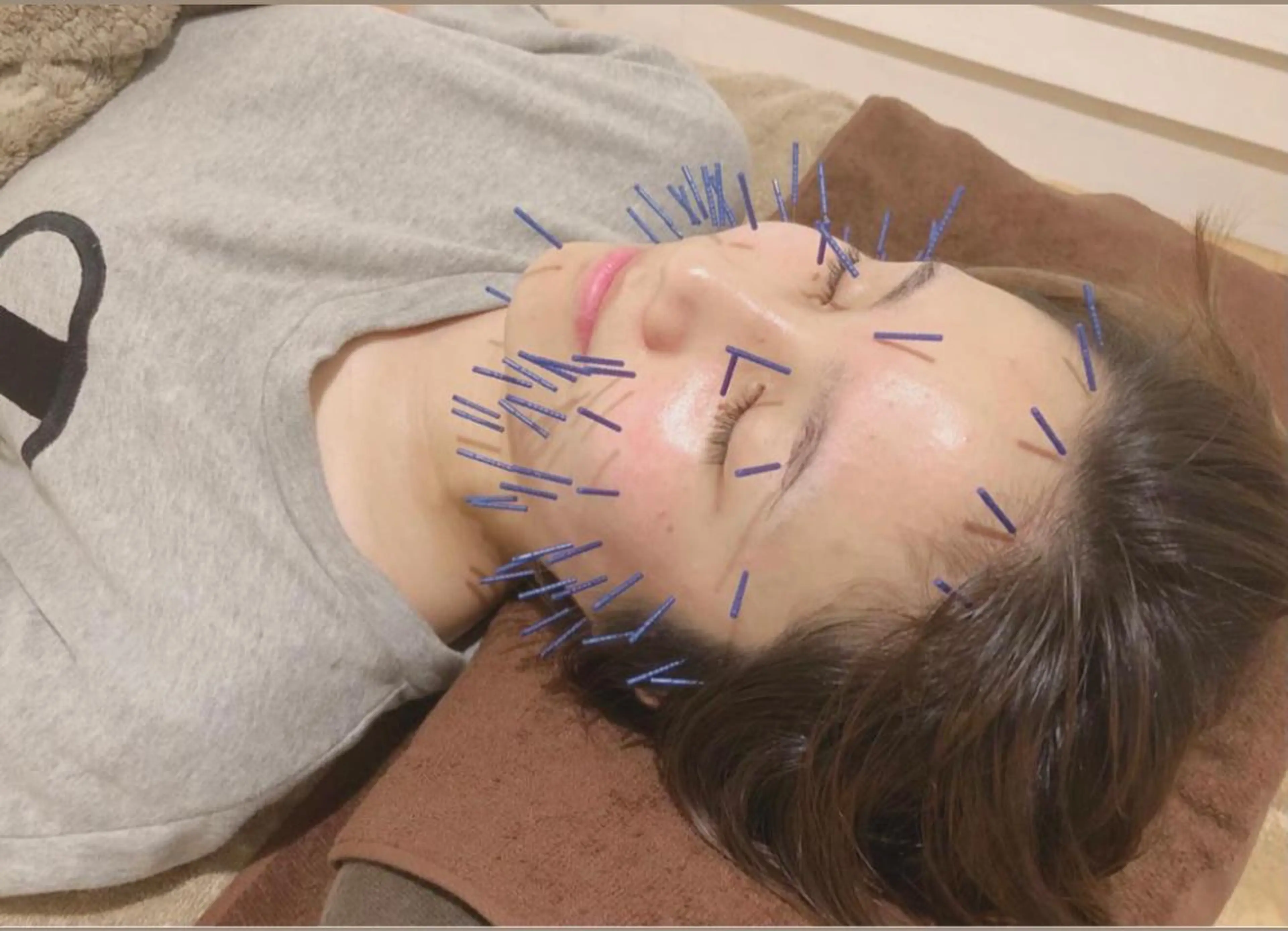 目黒/小顔/骨盤/ 美容鍼/美顔鍼/小林のエステ・リラクイメージ