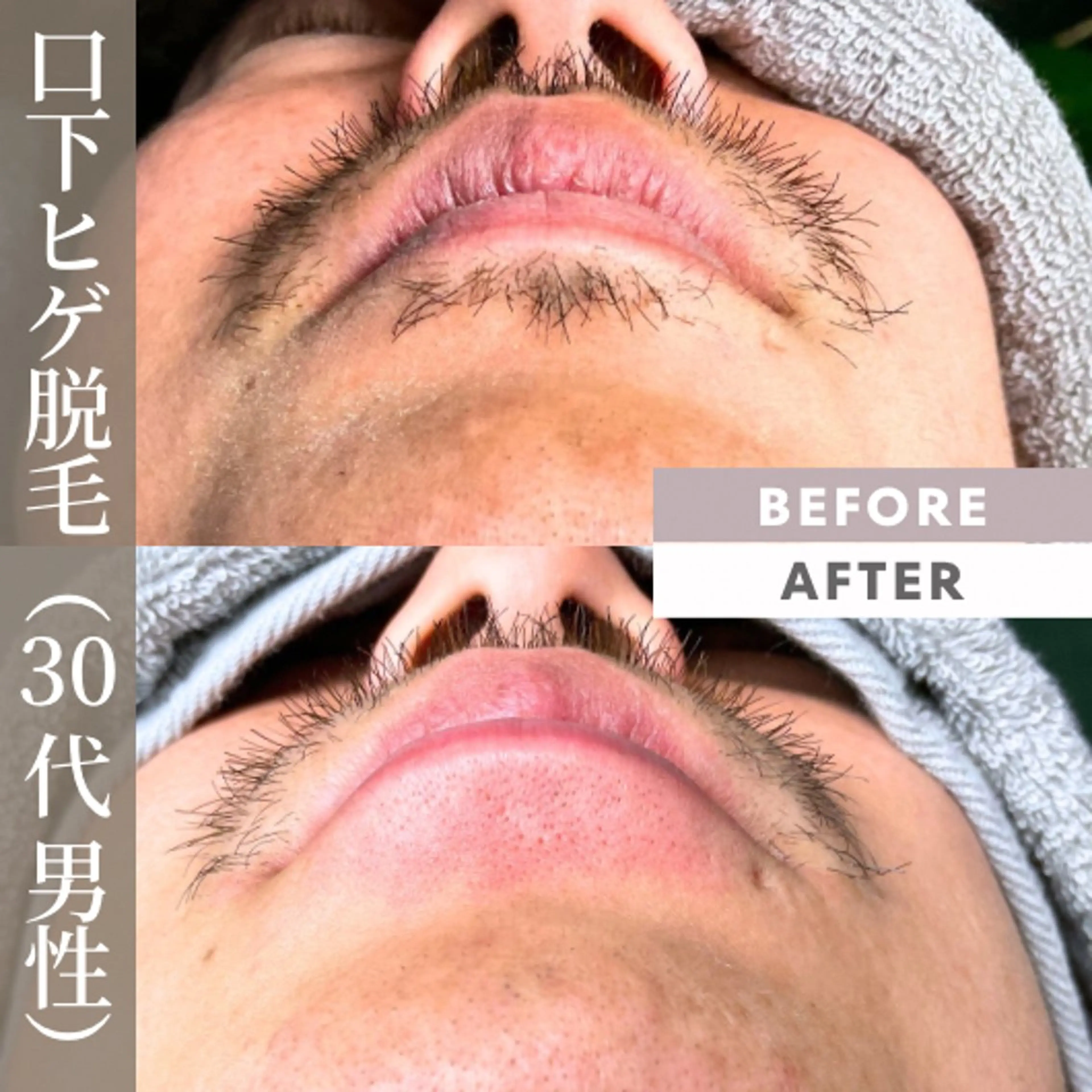 メンズ 【一本ずつ脱毛】 ReMove 柏のエステ・リラクイメージ