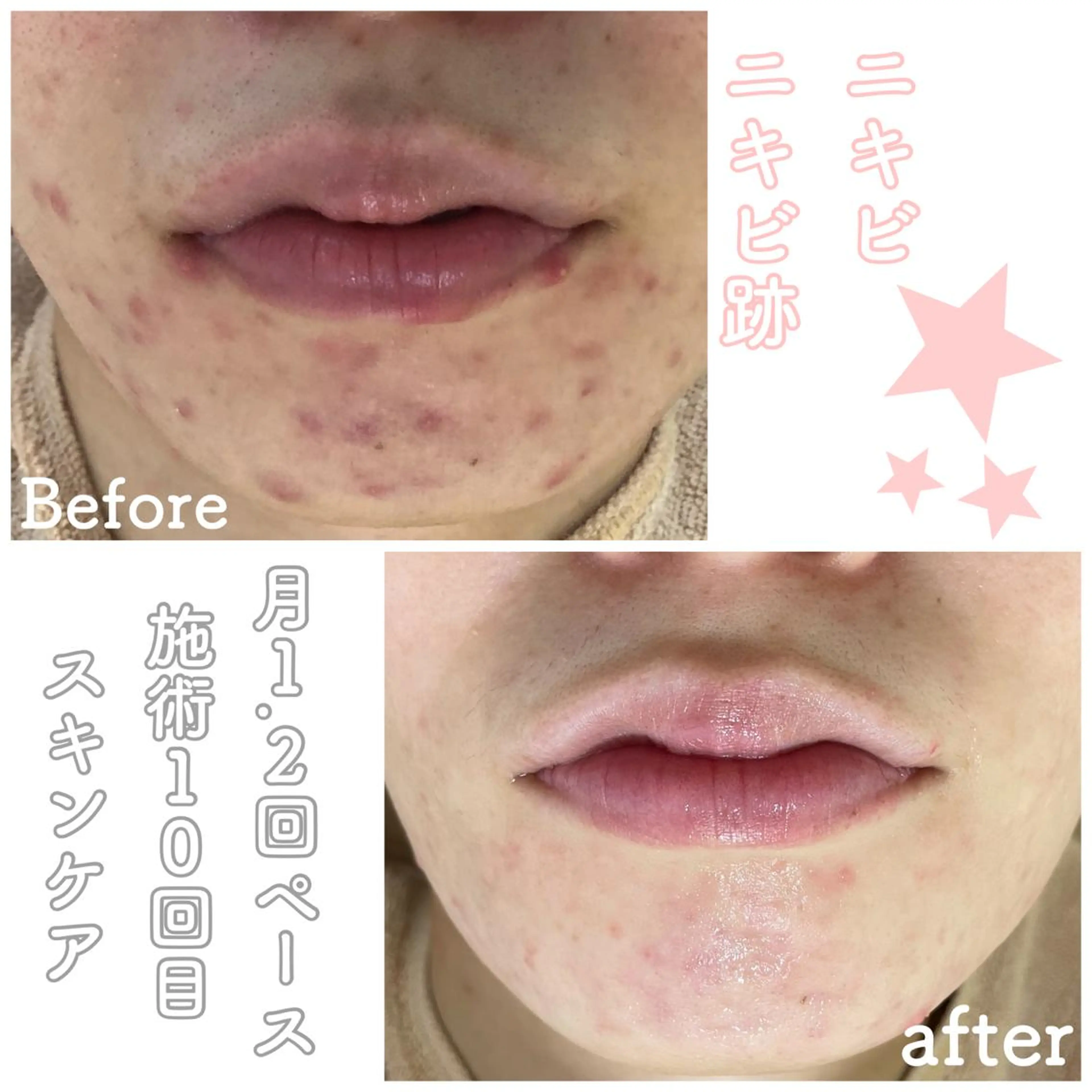 ミディアム カラー パーマ ヘアアレンジ メンズ キッズ ネイル マツエク・マツパ ニキビ&跡改善サロン オーナー光木のエステ・リラクイメージ