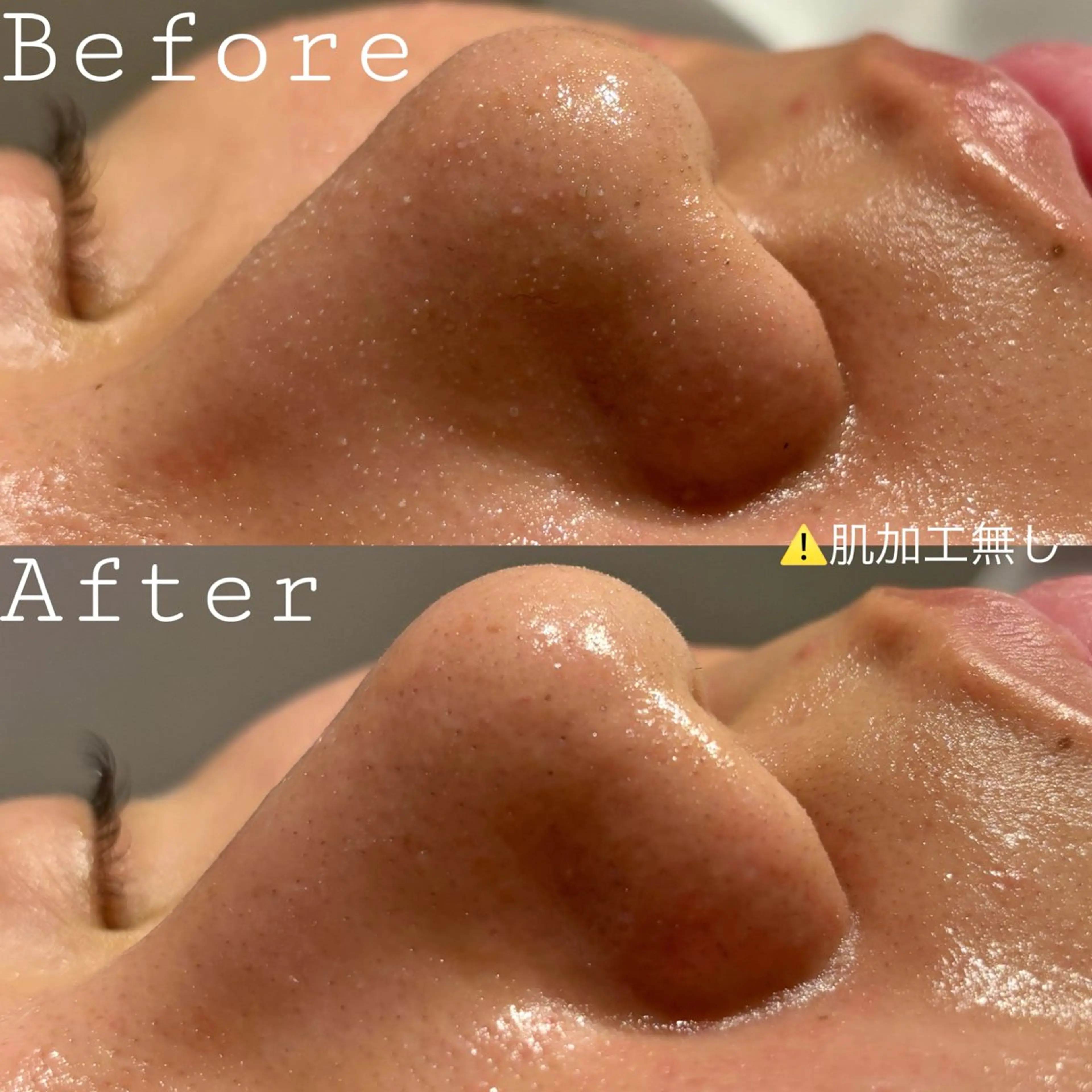 🌟ミニモ特別価格🌟いちご鼻さよなら👋【毛穴洗浄】ハイドロピーリング12,000→5,500の写真