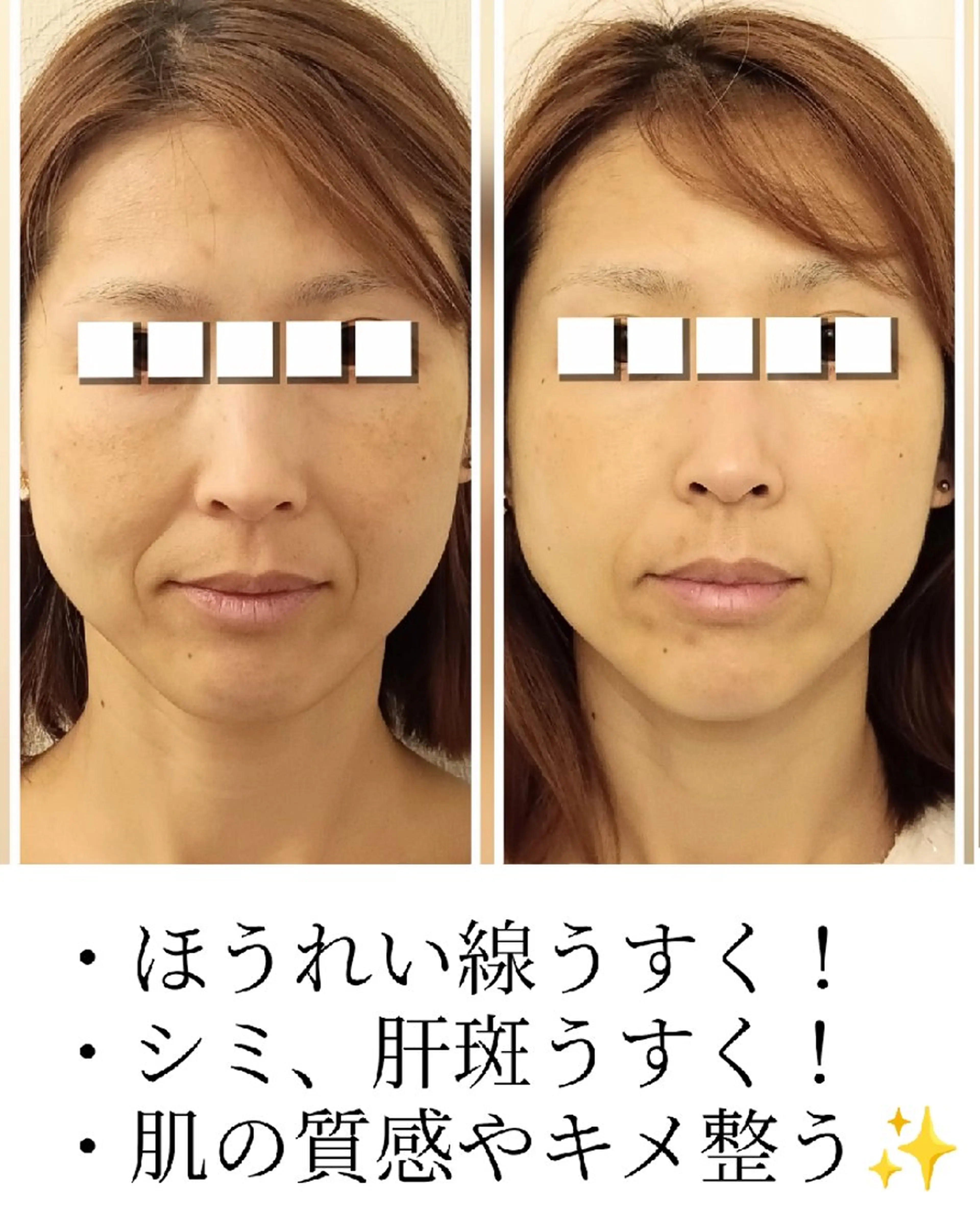 ハーブピーリング🌿剥離なし！シミ、シワ・たるみなどエイジングケアに最適♪の写真