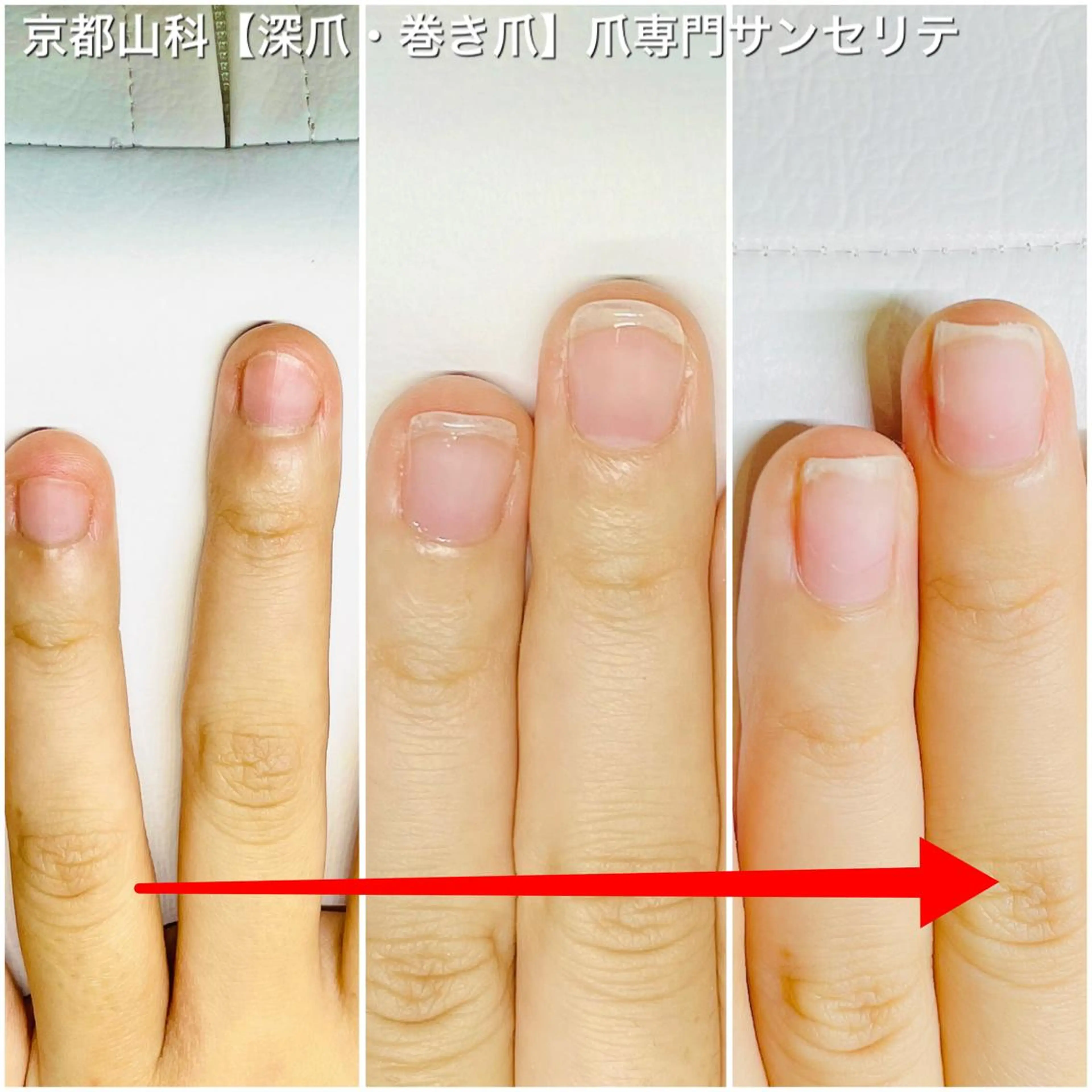 ハンドネイル ハンドケア 深爪・巻き爪 専門サンセリテのネイルデザイン