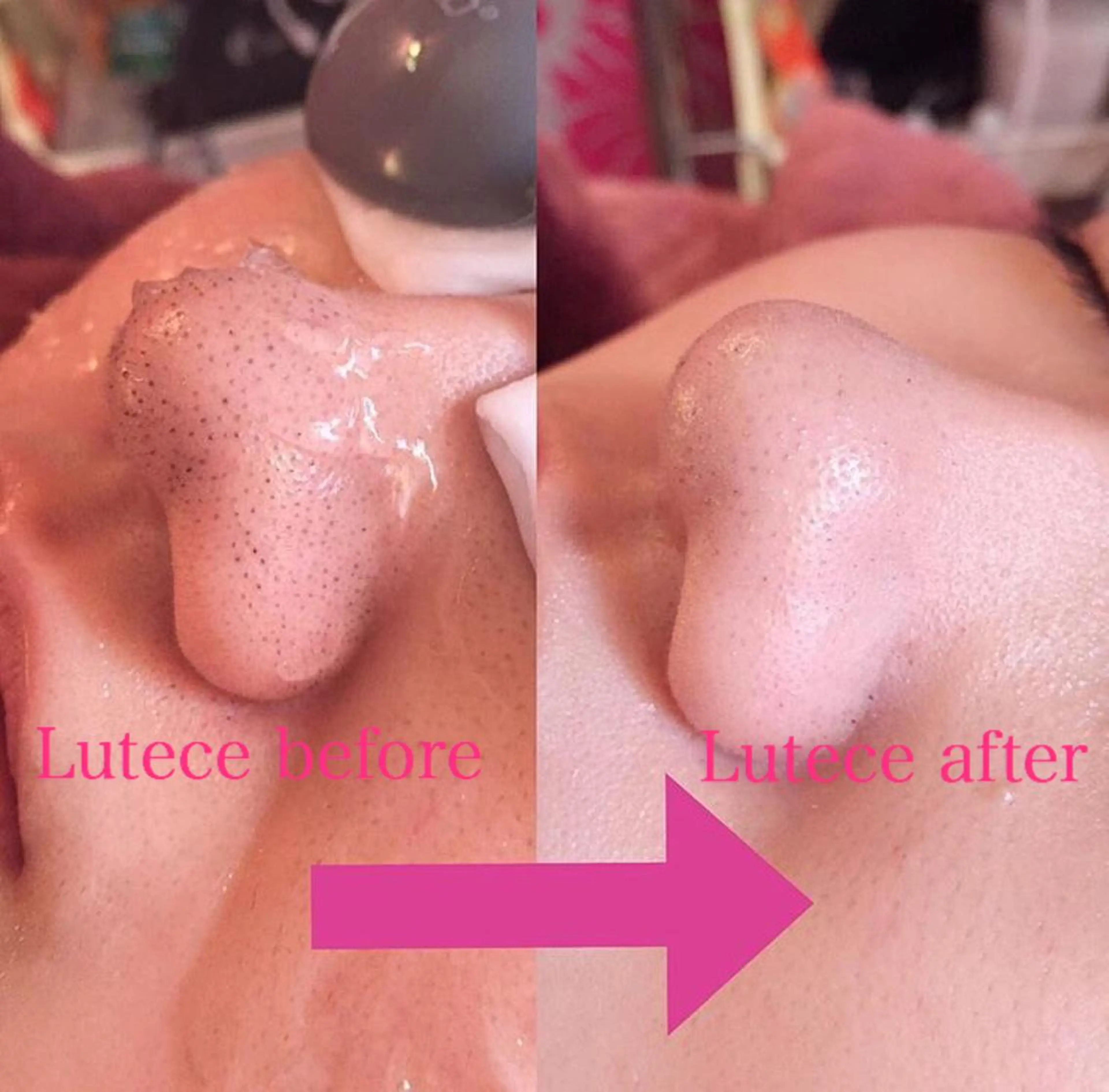 毛穴掃除+お顔脱毛+ぷるぷるパックの写真