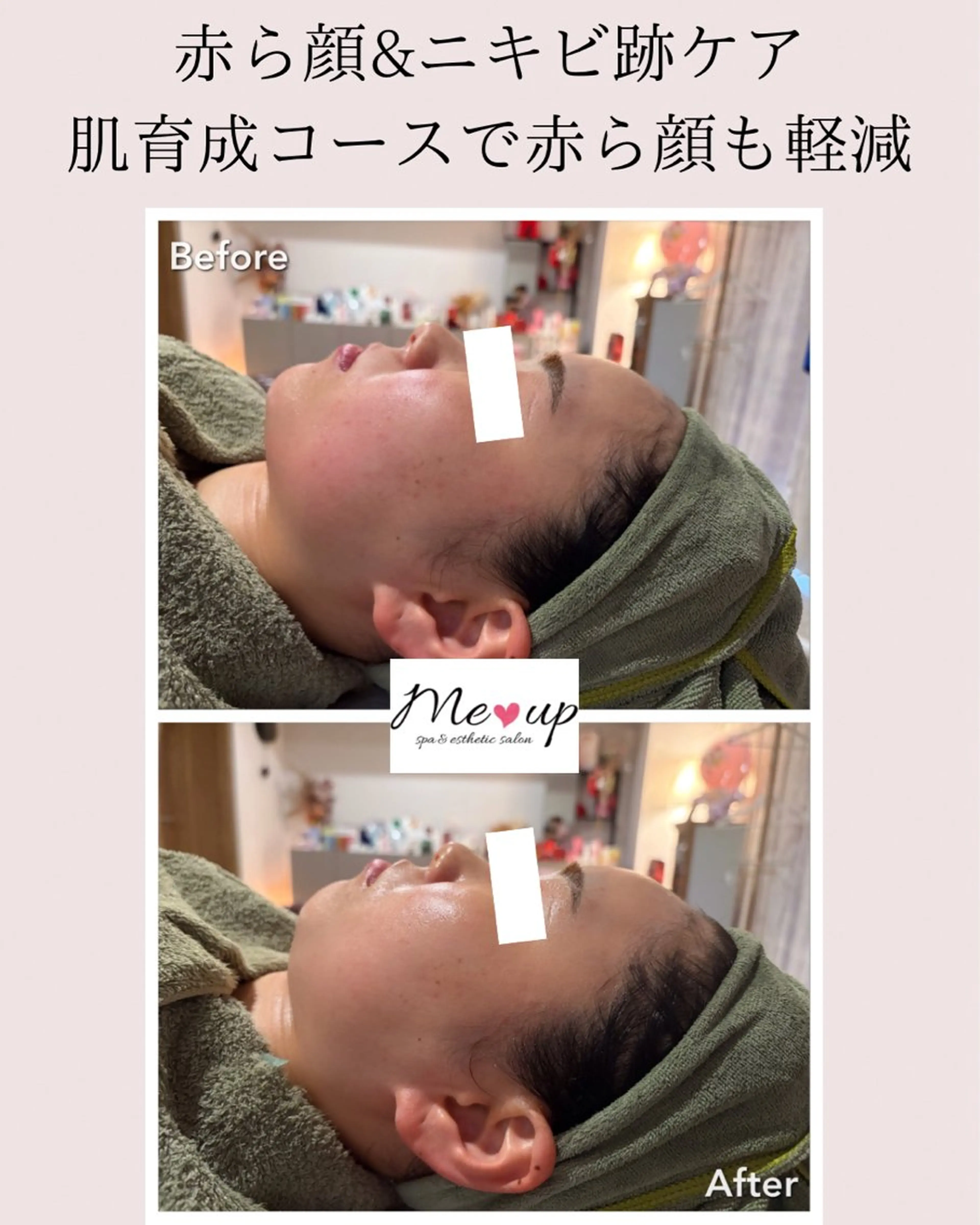 Meupニキビ専門店 背中/ハーブ/肌管理のその他イメージ