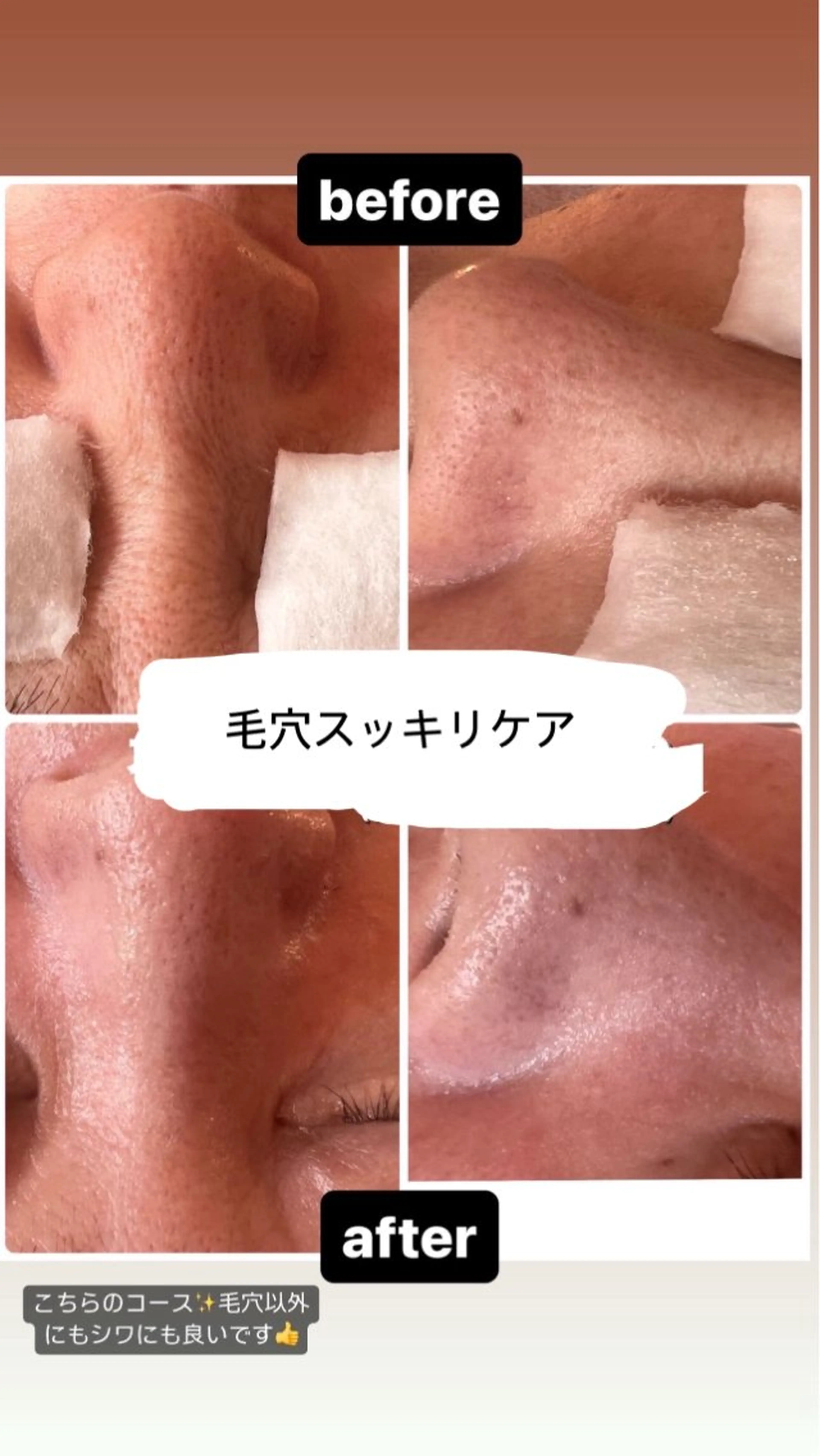 初回40%オフ✨ごわつき毛穴もスッキリ😆フェイシャルコース✨90分の写真