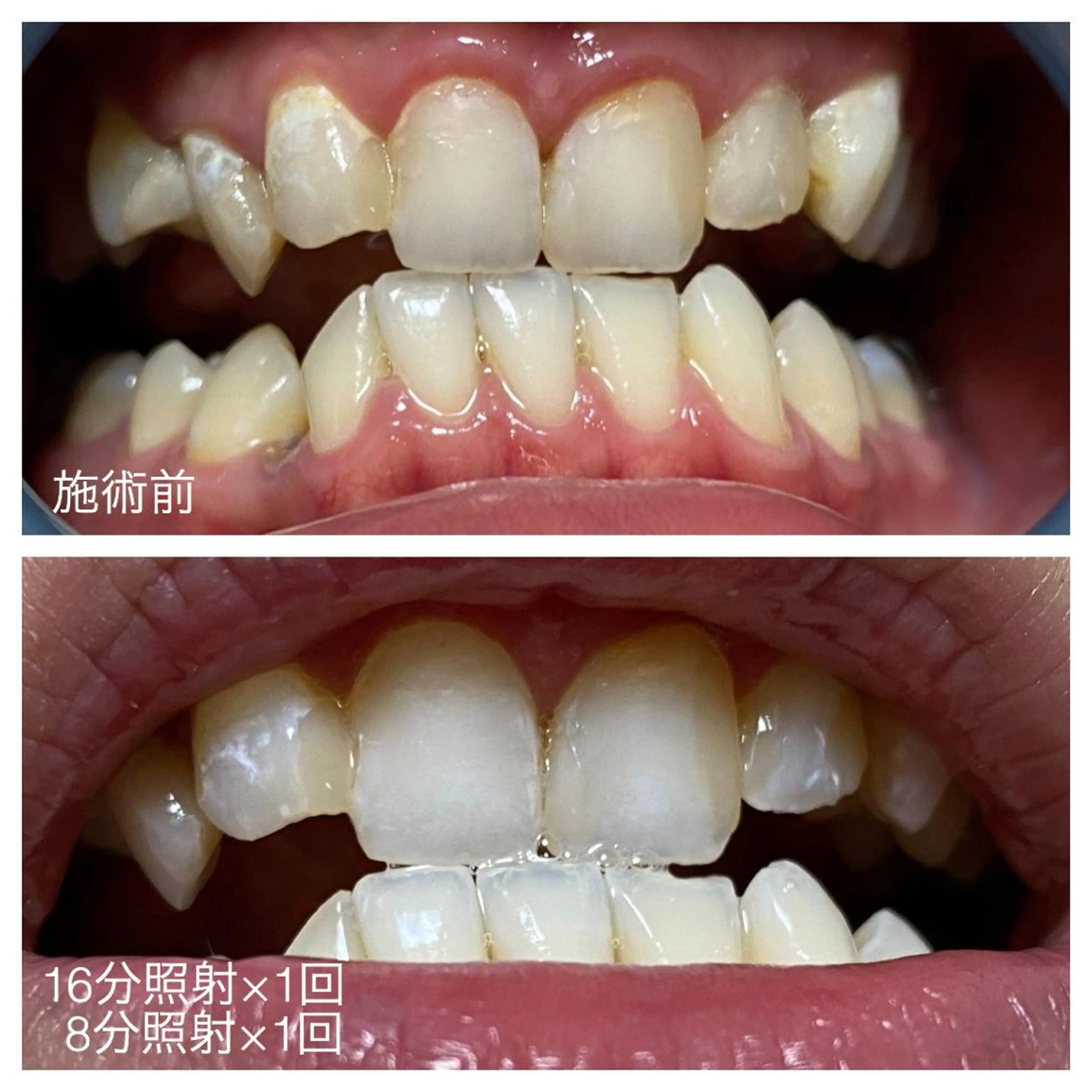 ネイル/耳つぼ /新ホワイトニングのネイルデザイン