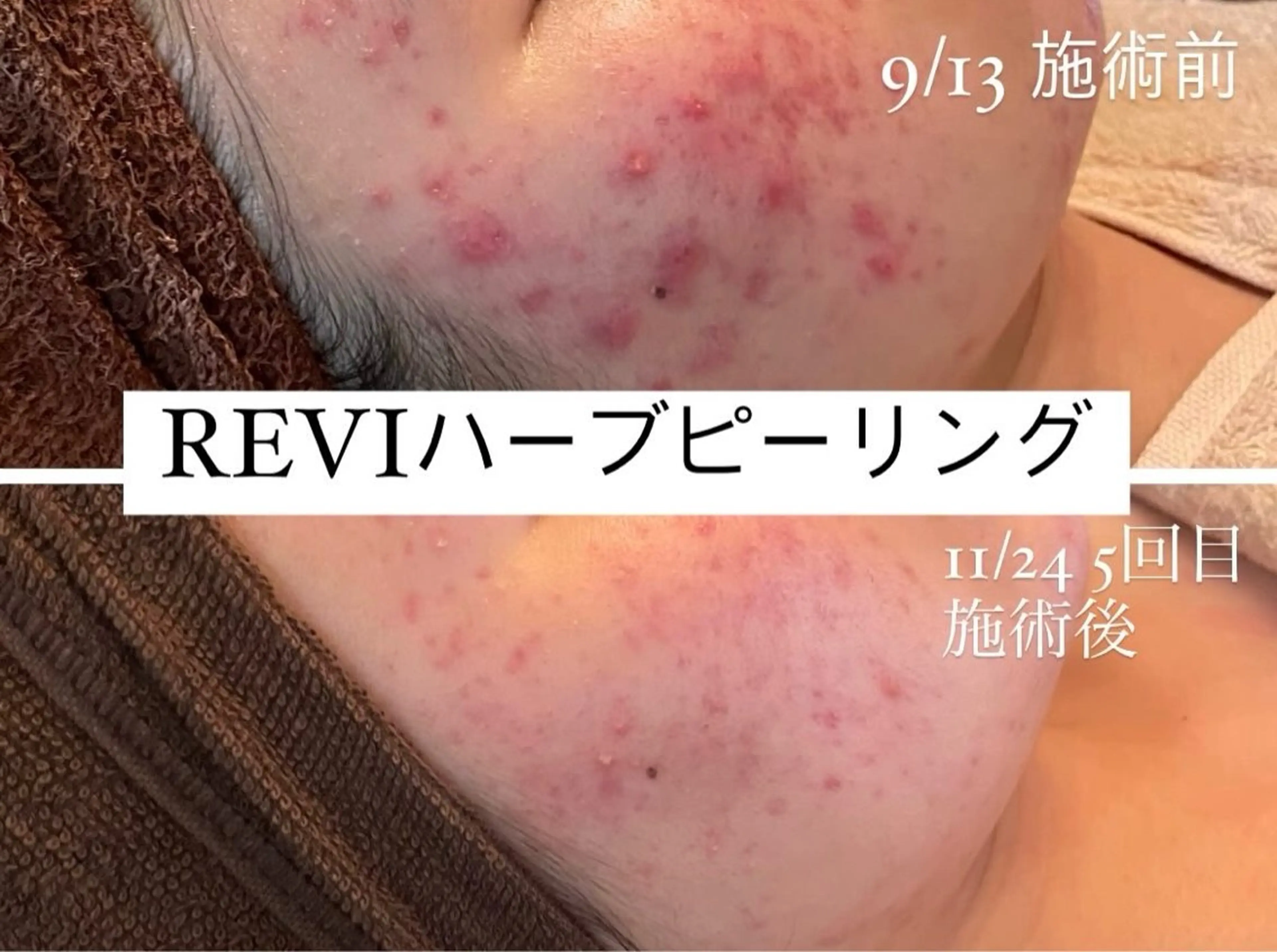 エステ 🌿ハーブピーリング ・脱毛◆Refreのエステ・リラクイメージ