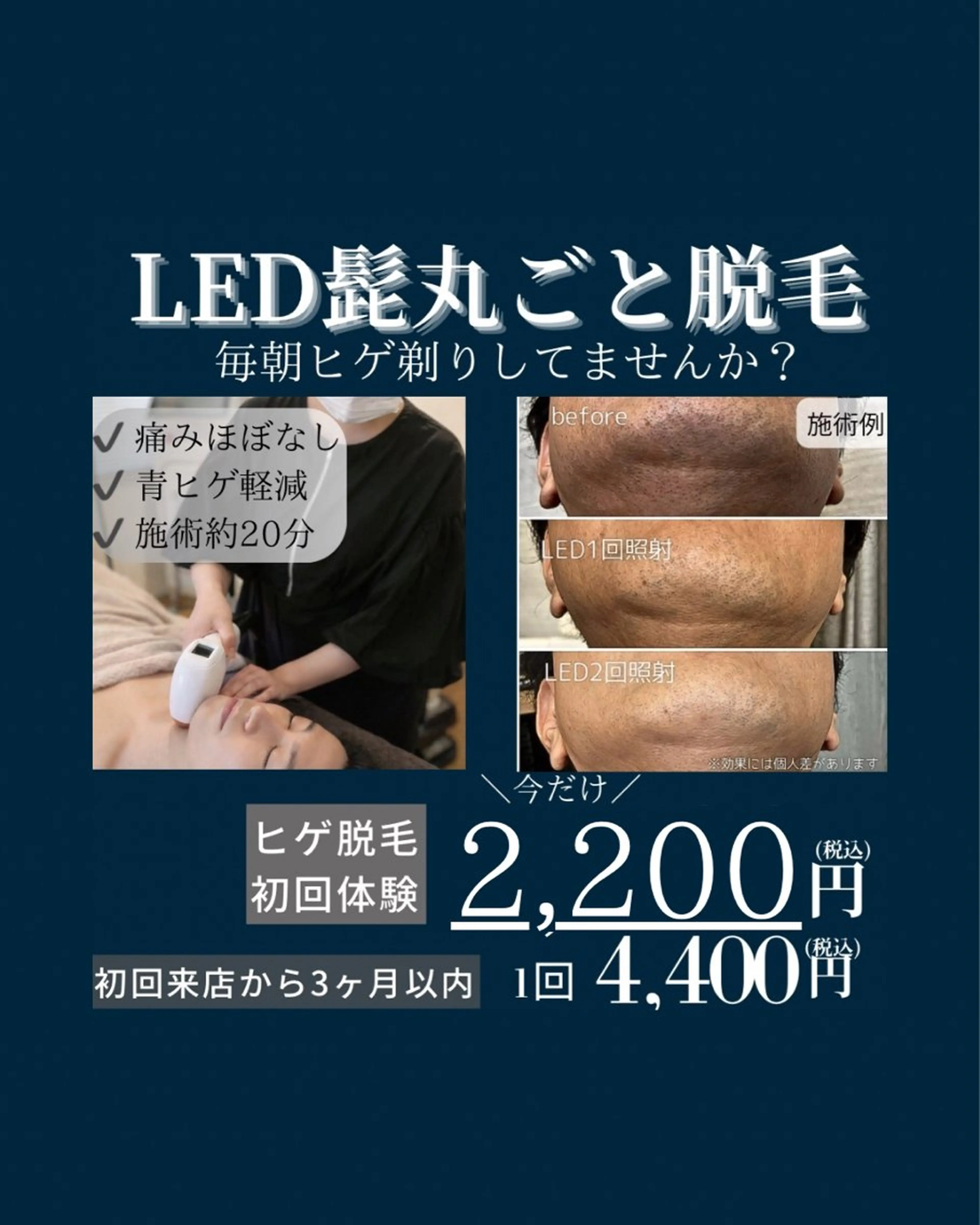 人気No. 2🟦メンズ限定🟦ヒゲ脱毛✨の写真