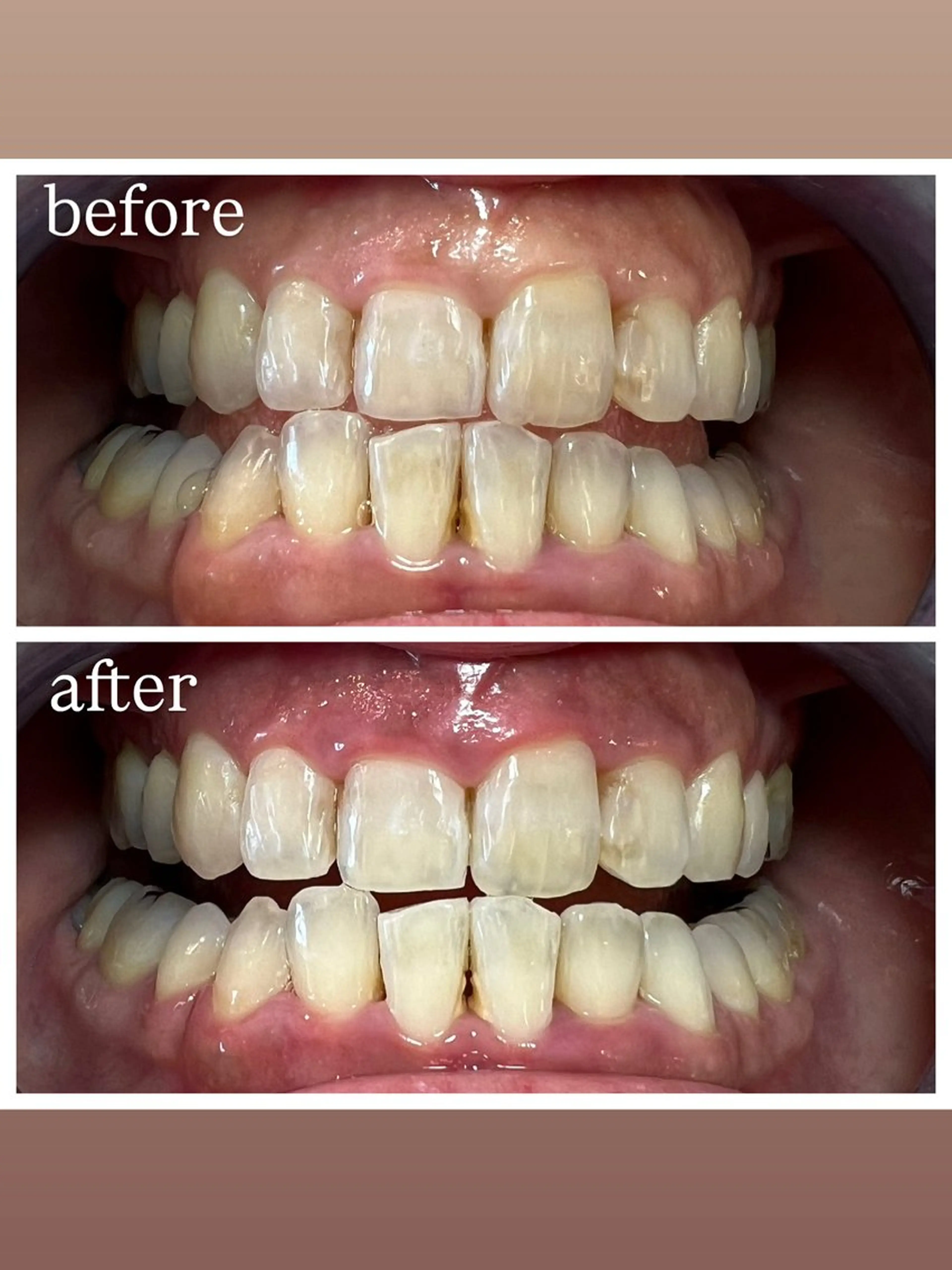 セルフホワイトニング Shineeのエステ・リラクイメージ