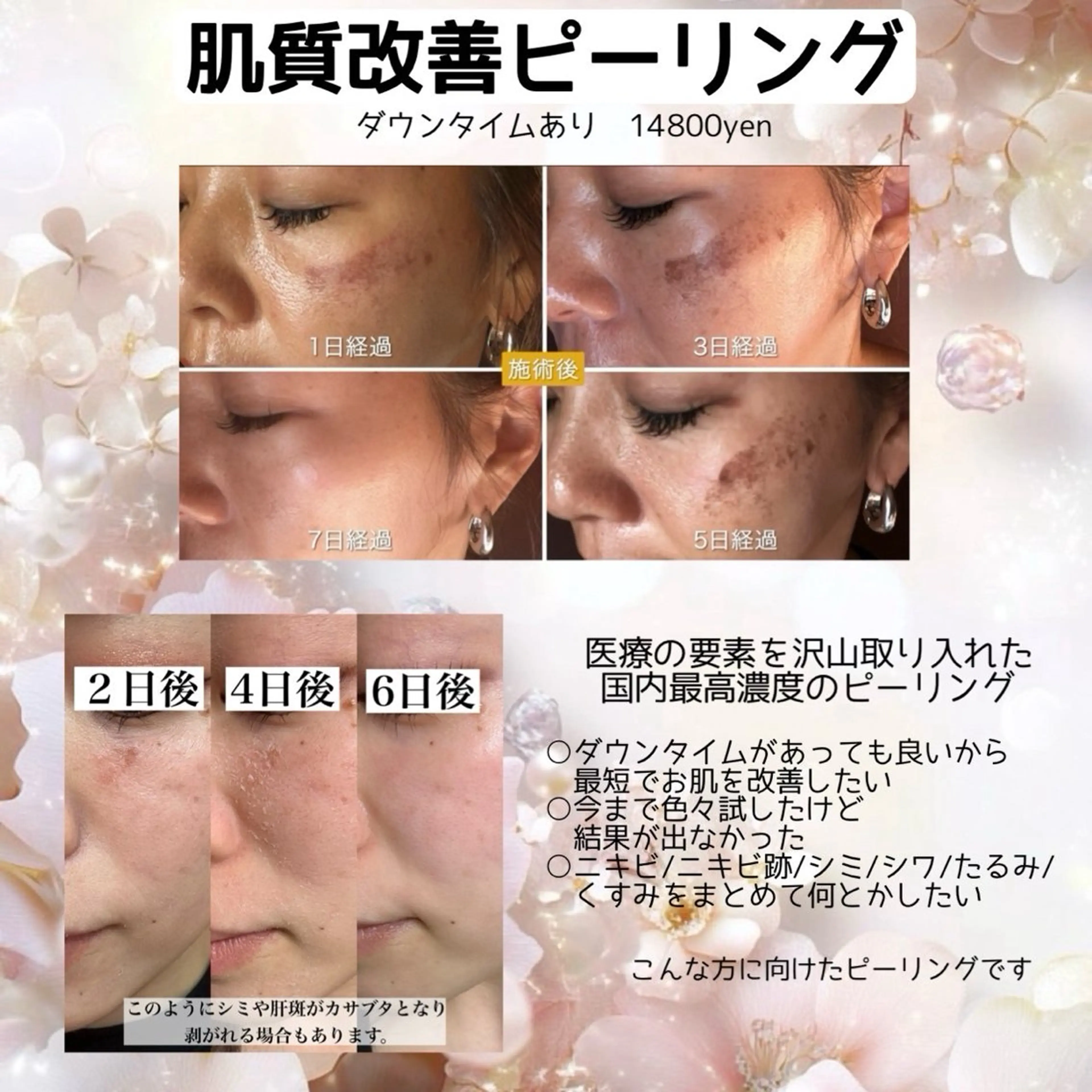 【国内最高濃度ピーリング】韓国美肌/ニキビケアの写真