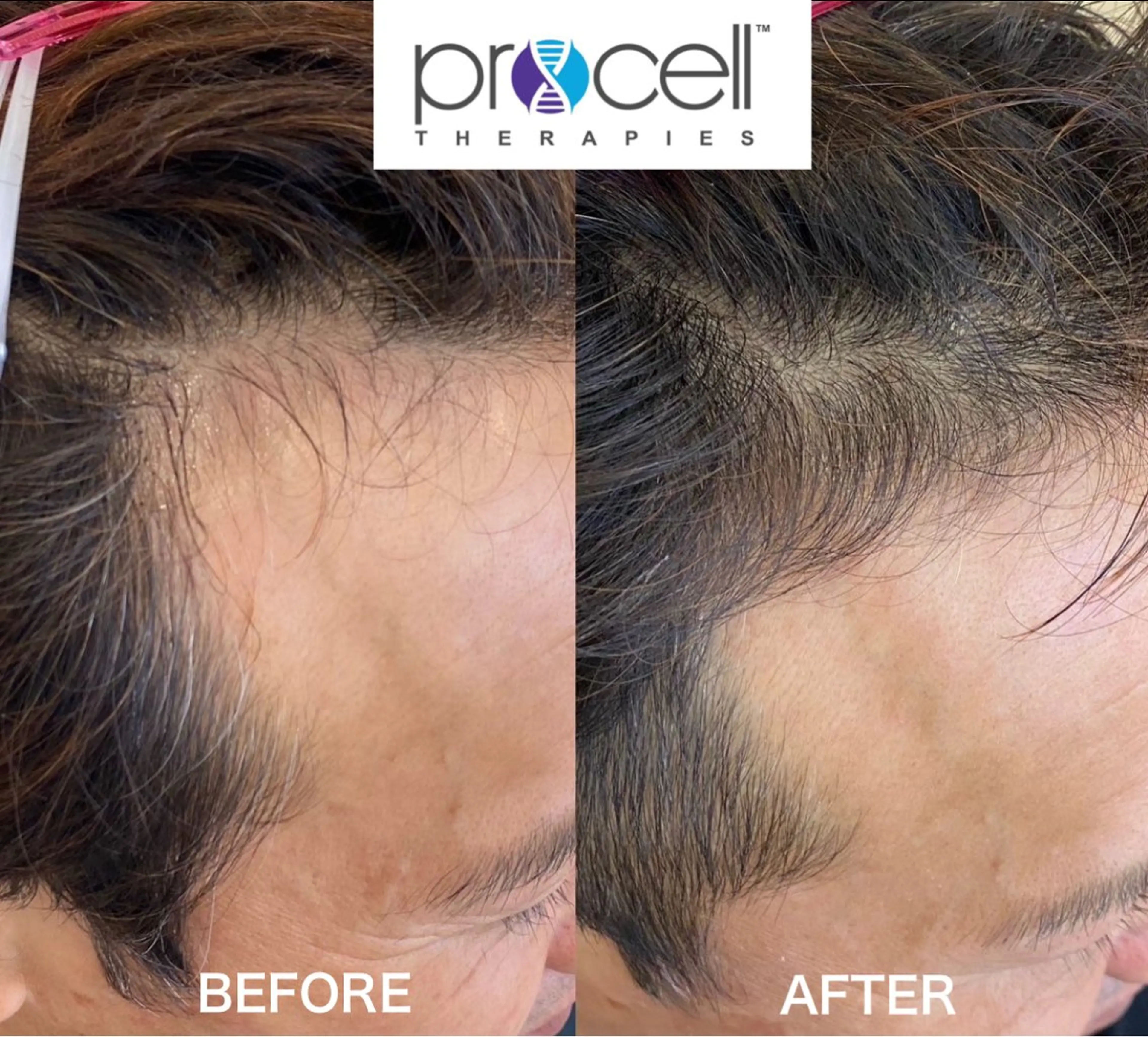 プロセルセラピーズ・頭浸浴・ヘッドスパセットの写真