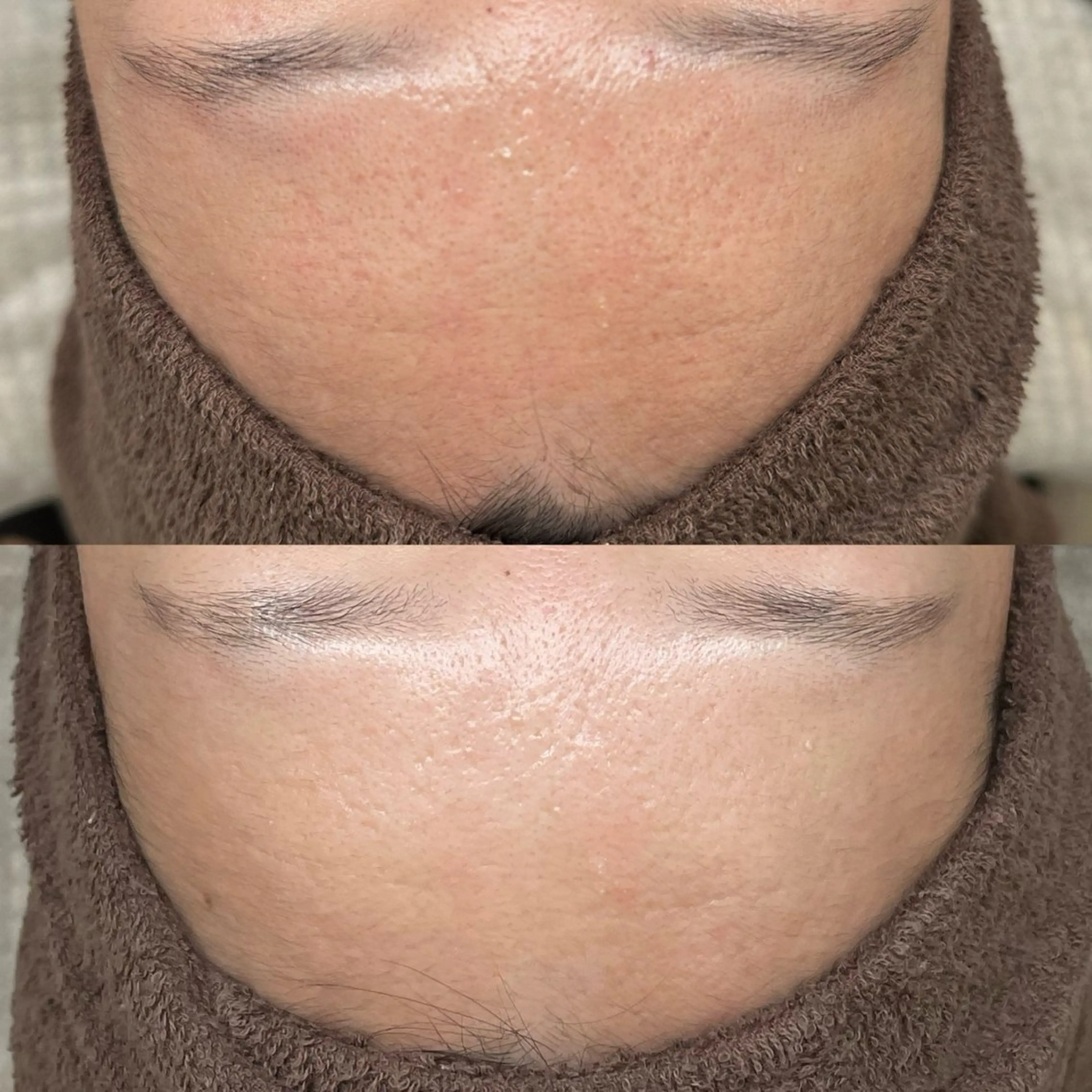 【高知初】メソスキンカラー🪡トーンアップ・しわ改善の写真