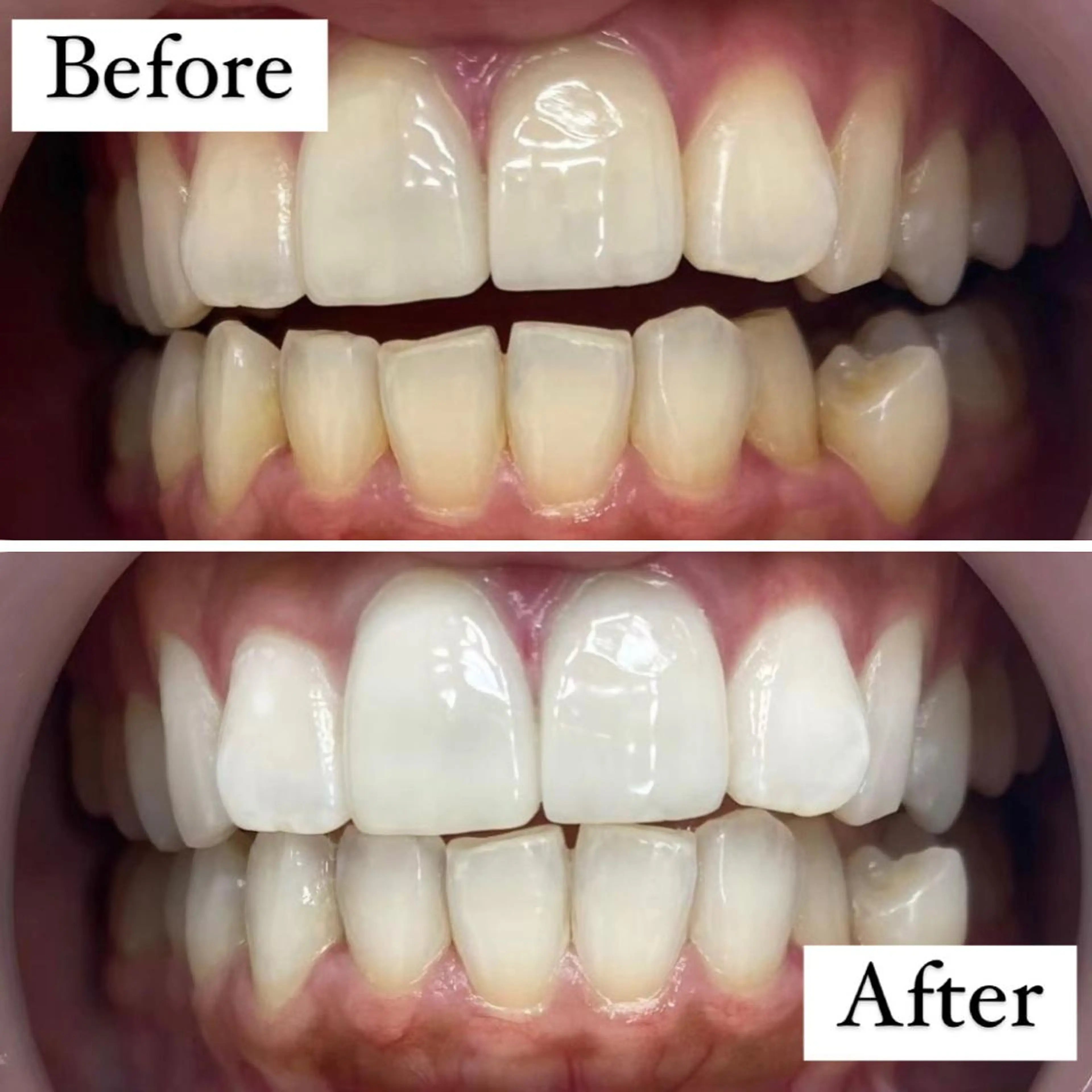 【人気No.1👑】5分照射×2回✨照射パワー2倍で効果実感‼効果抜群の最新セルフホワイトニング🦷の写真