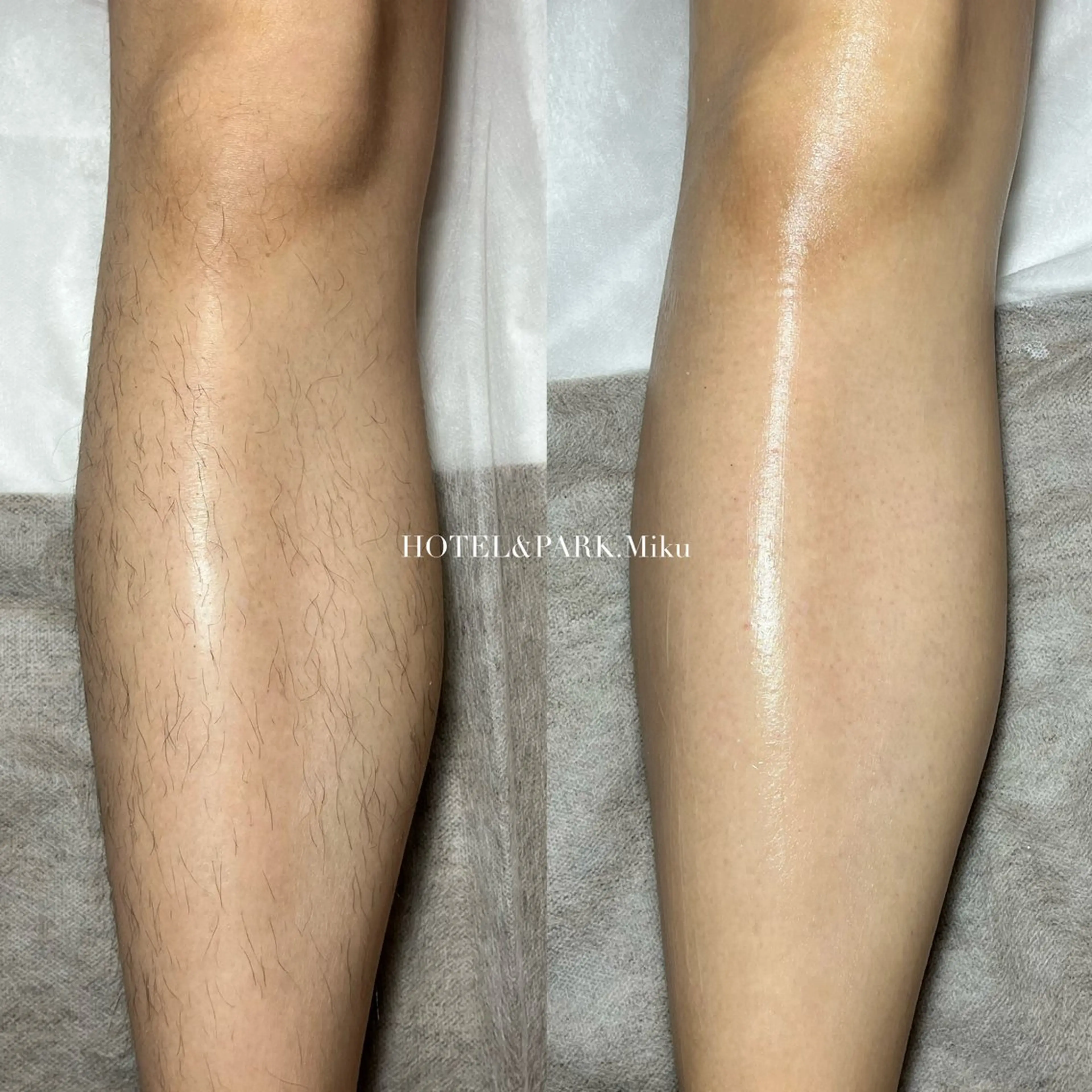 HOTEL&PARK . ワックス脱毛のエステ・リラクイメージ