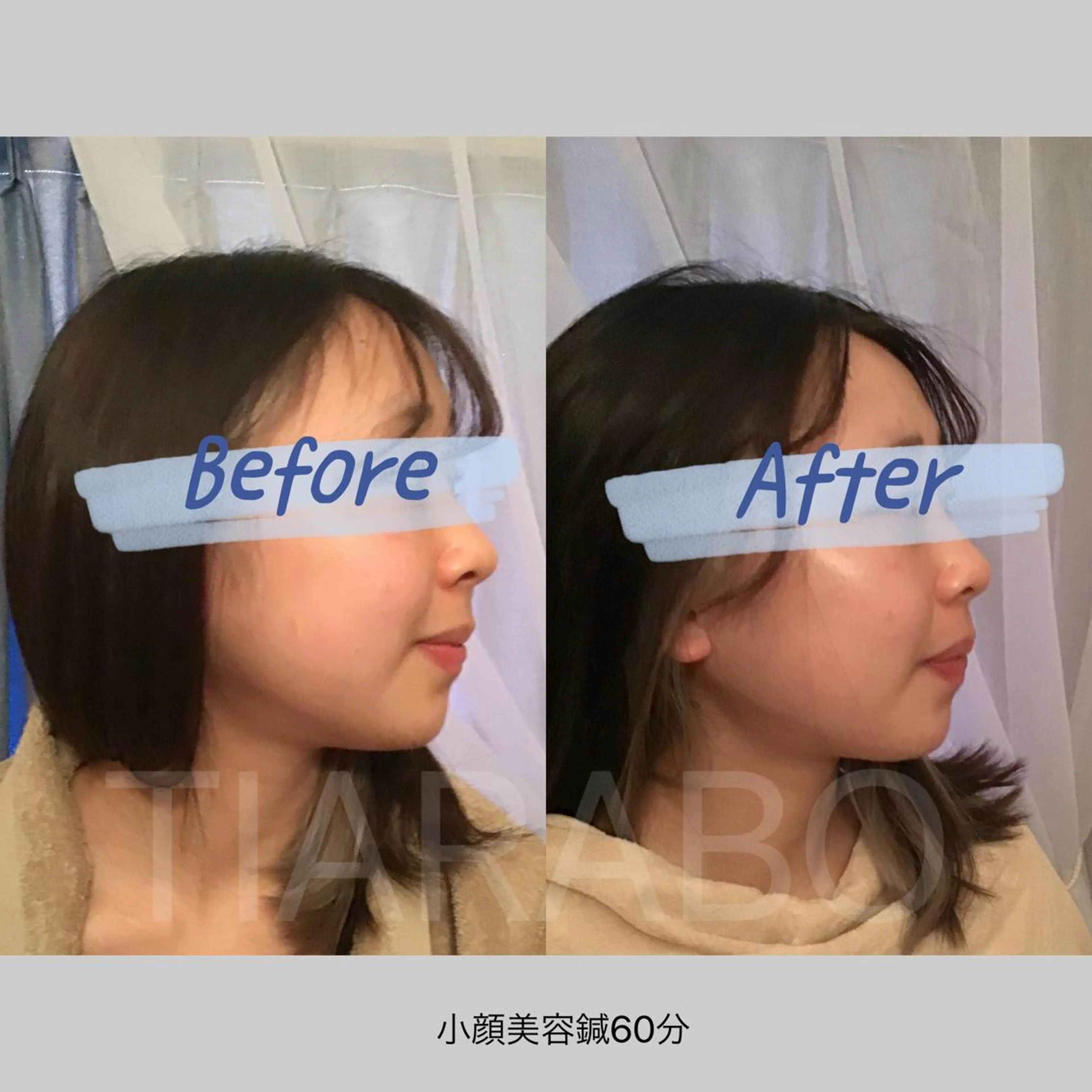 人気No.1★【小顔美容鍼60分】クレンジング/小顔電気鍼+ラジオ波or顔筋リフレ+筋膜ほぐし/ヒト幹整肌/ヘッド首肩の写真